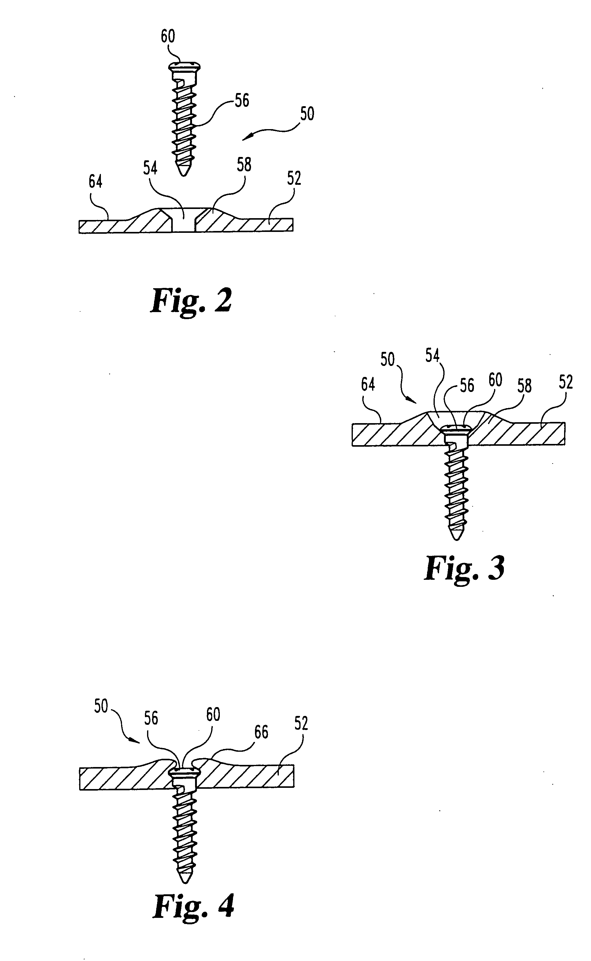 Non-metallic implant devices and intra-operative methods for assembly and fixation