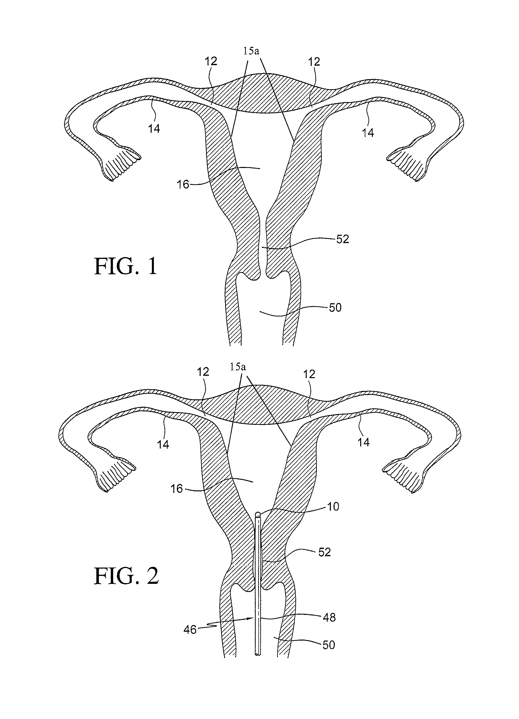 Intrauterine device