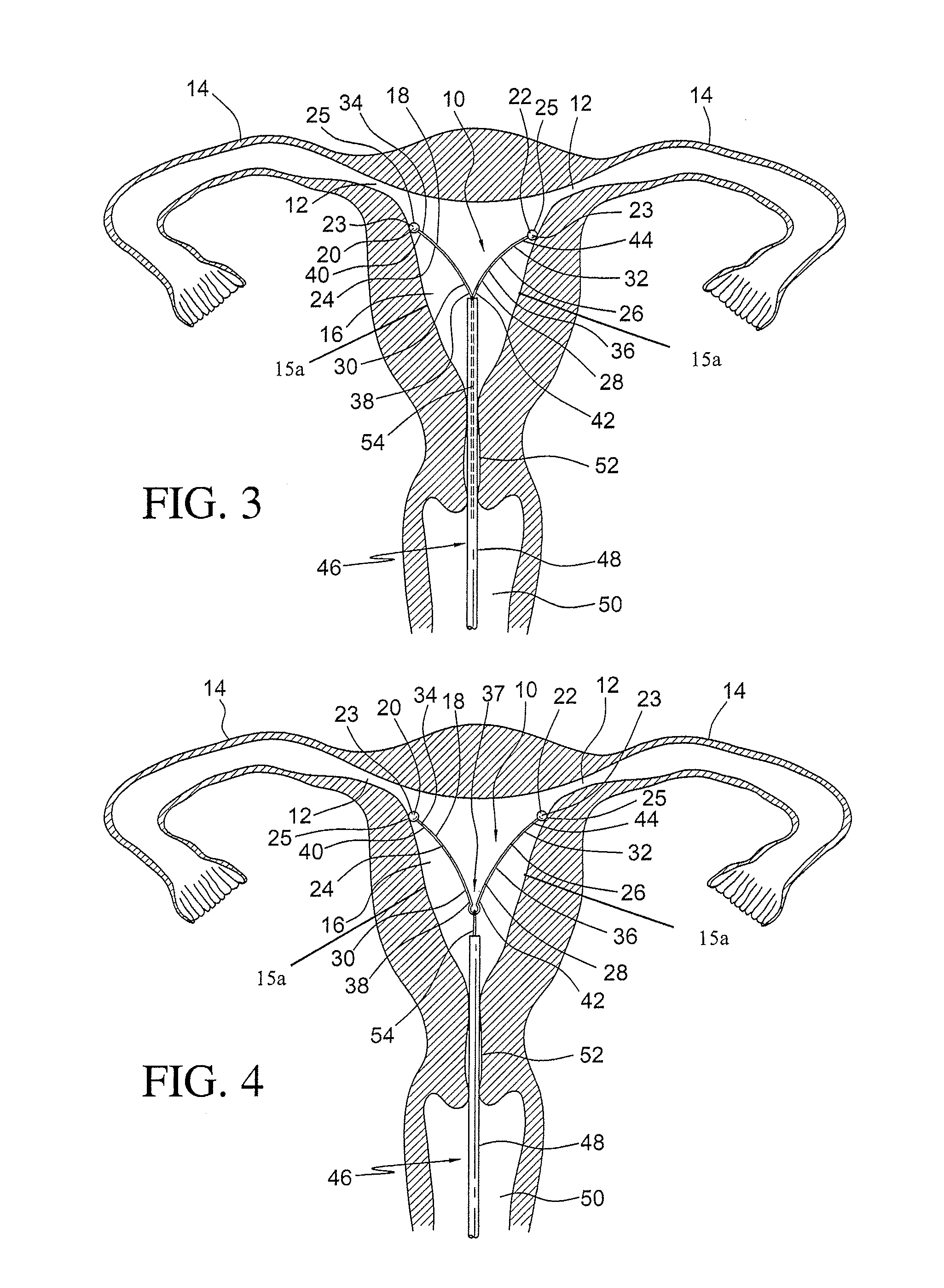 Intrauterine device