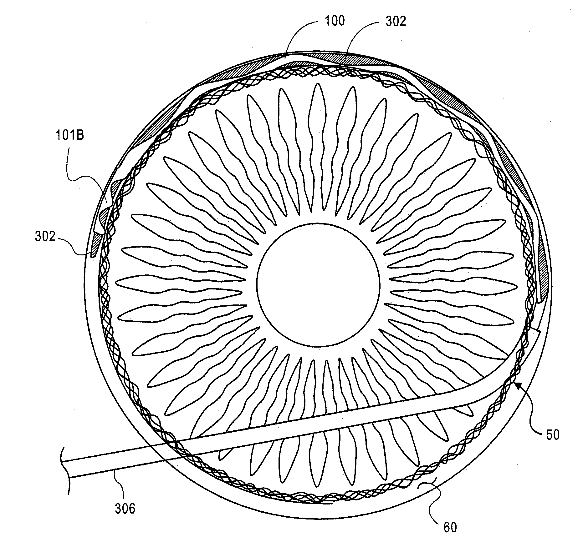 Methods and Apparatus for Treating Glaucoma