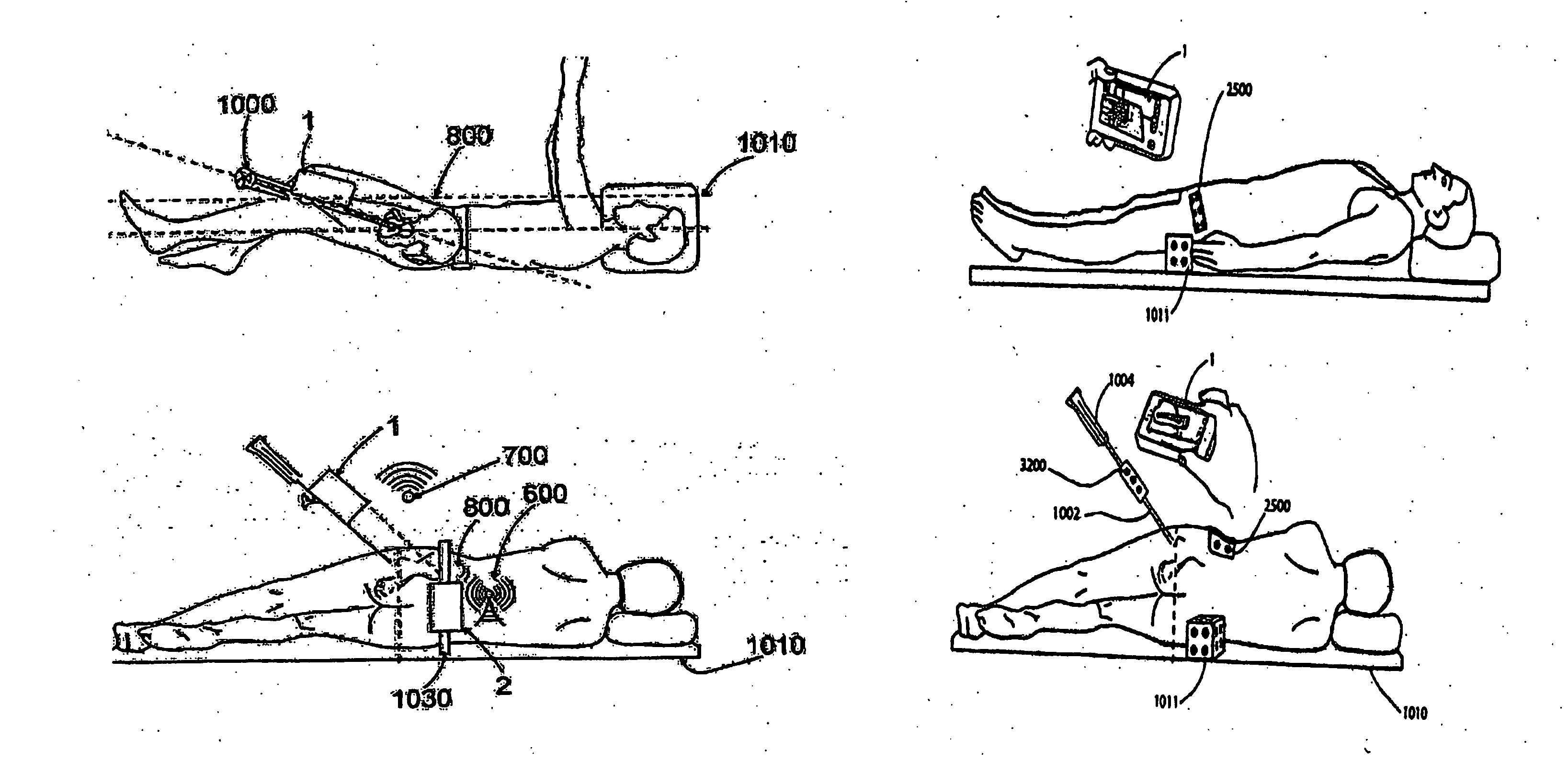 Handheld tracking system and devices for aligning implant systems during surgery
