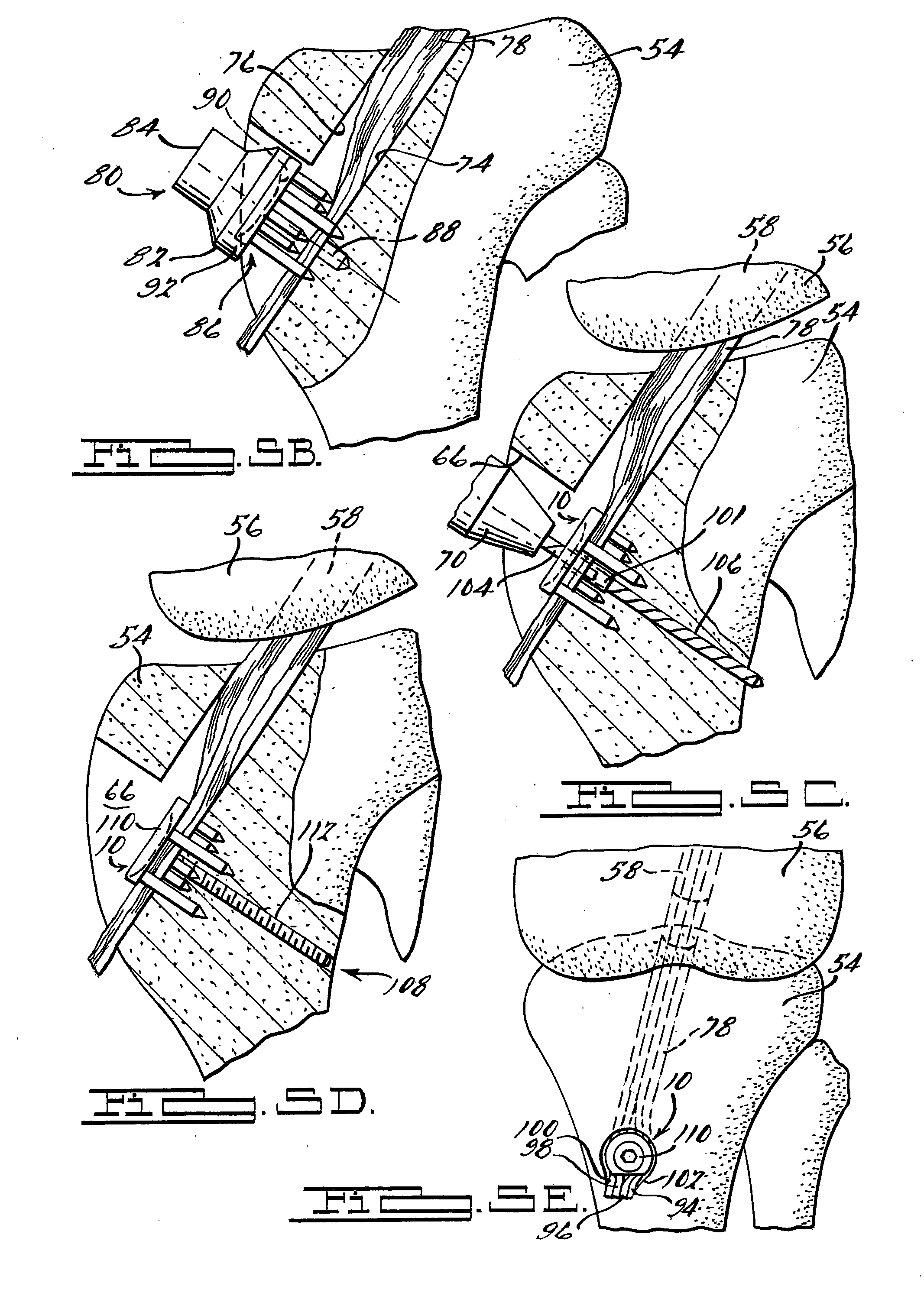 Apparatus and Method for Tibial Fixation of Soft Tissue