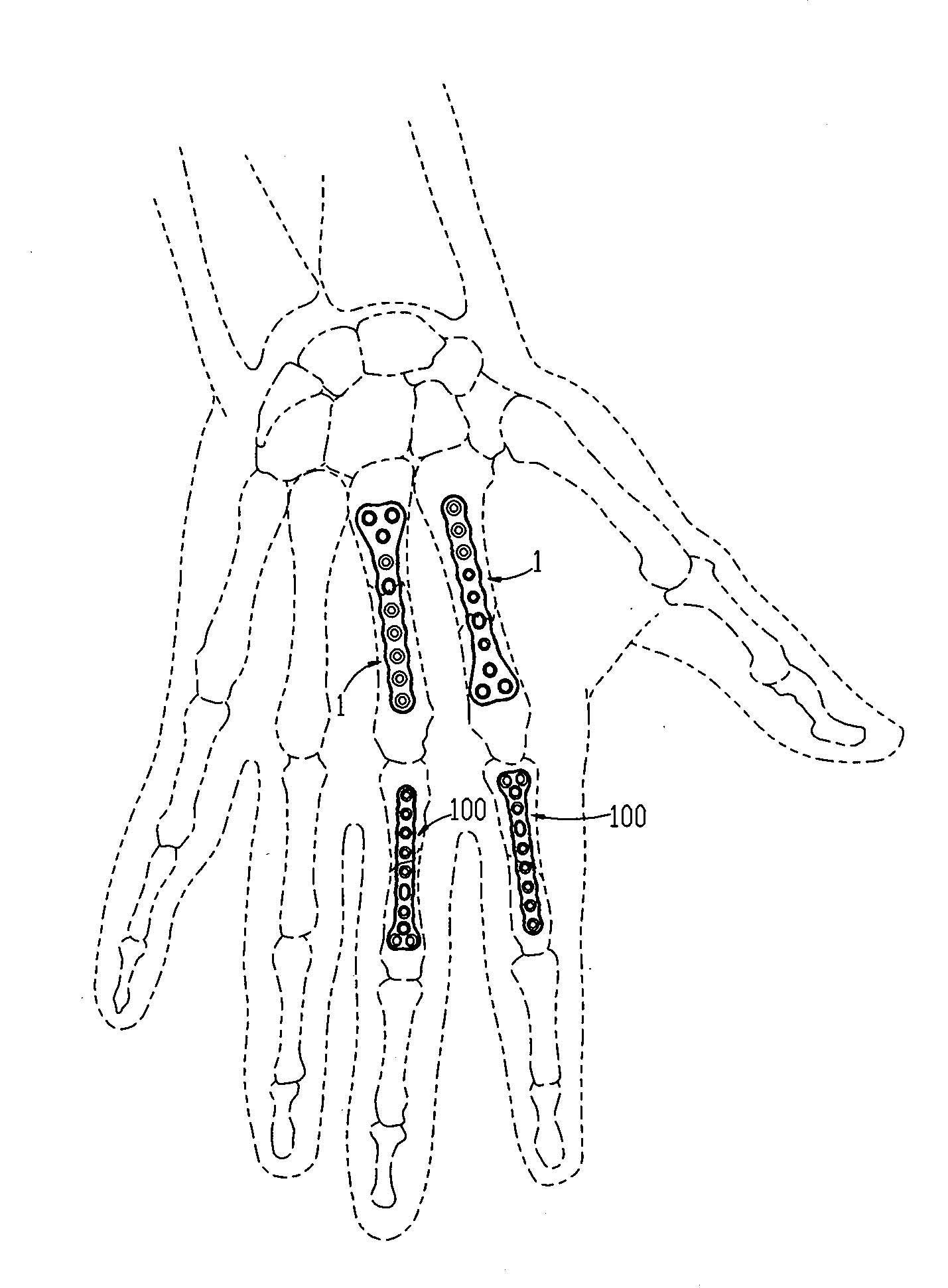 Subcondylar fracture fixation plate system for tubular bones of the hand