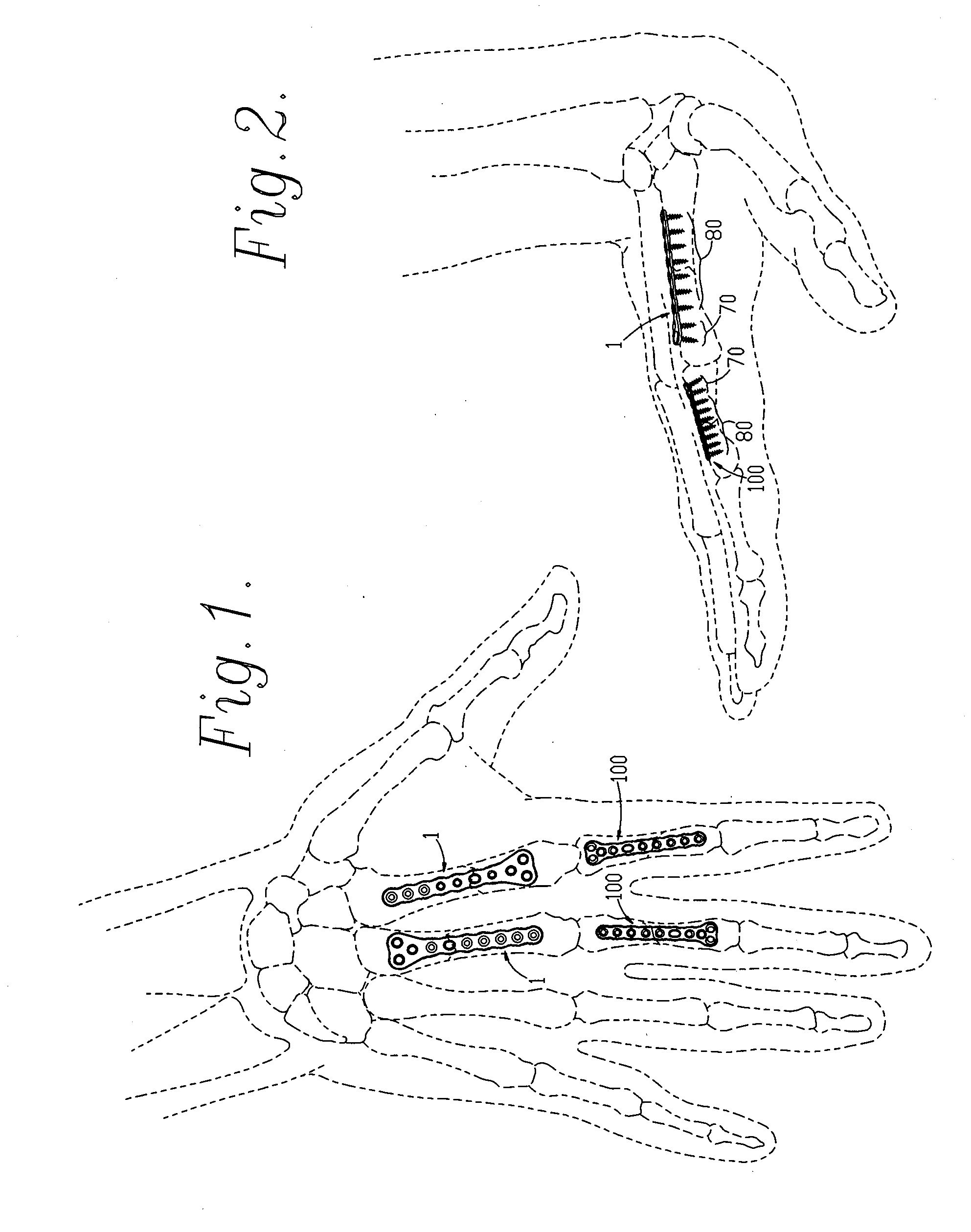 Subcondylar fracture fixation plate system for tubular bones of the hand