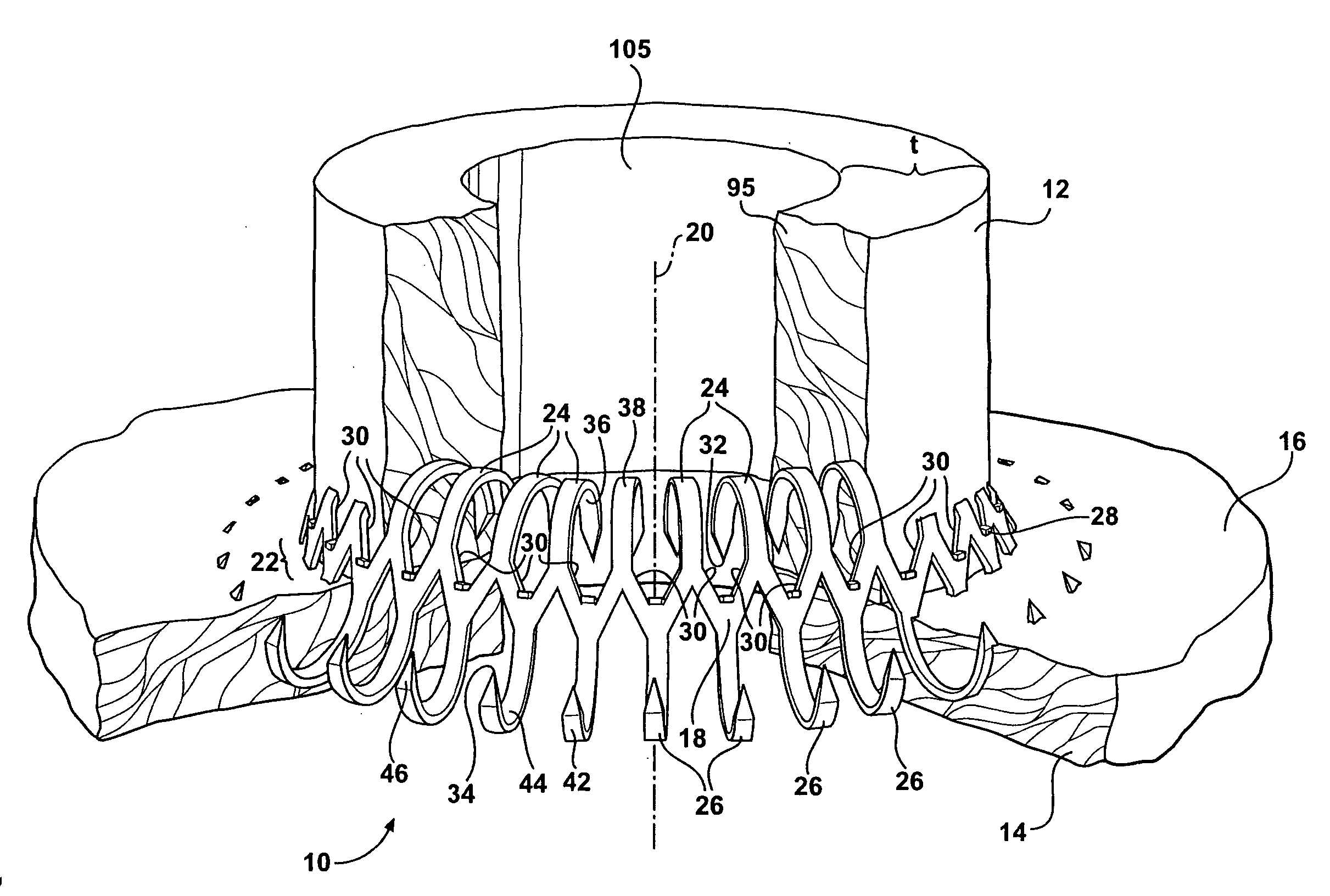 Anastomosis apparatus and methods of deployment and manufacture