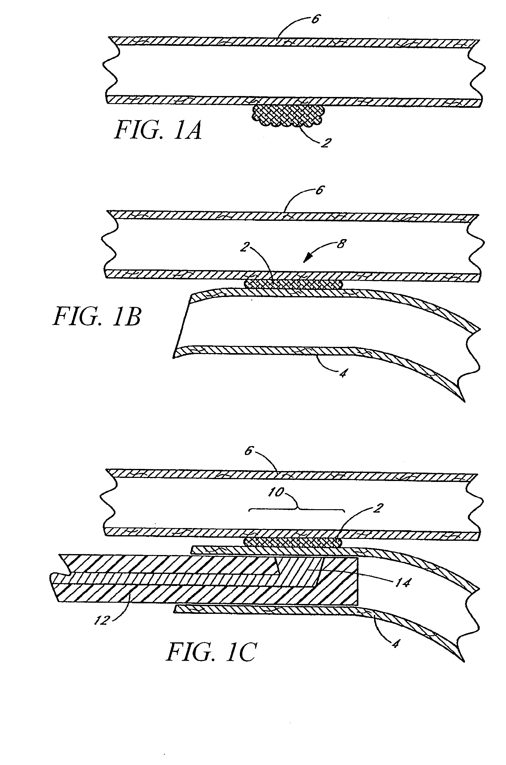 Apparatus and method for performing laser-assisted vascular anastomoses using bioglue
