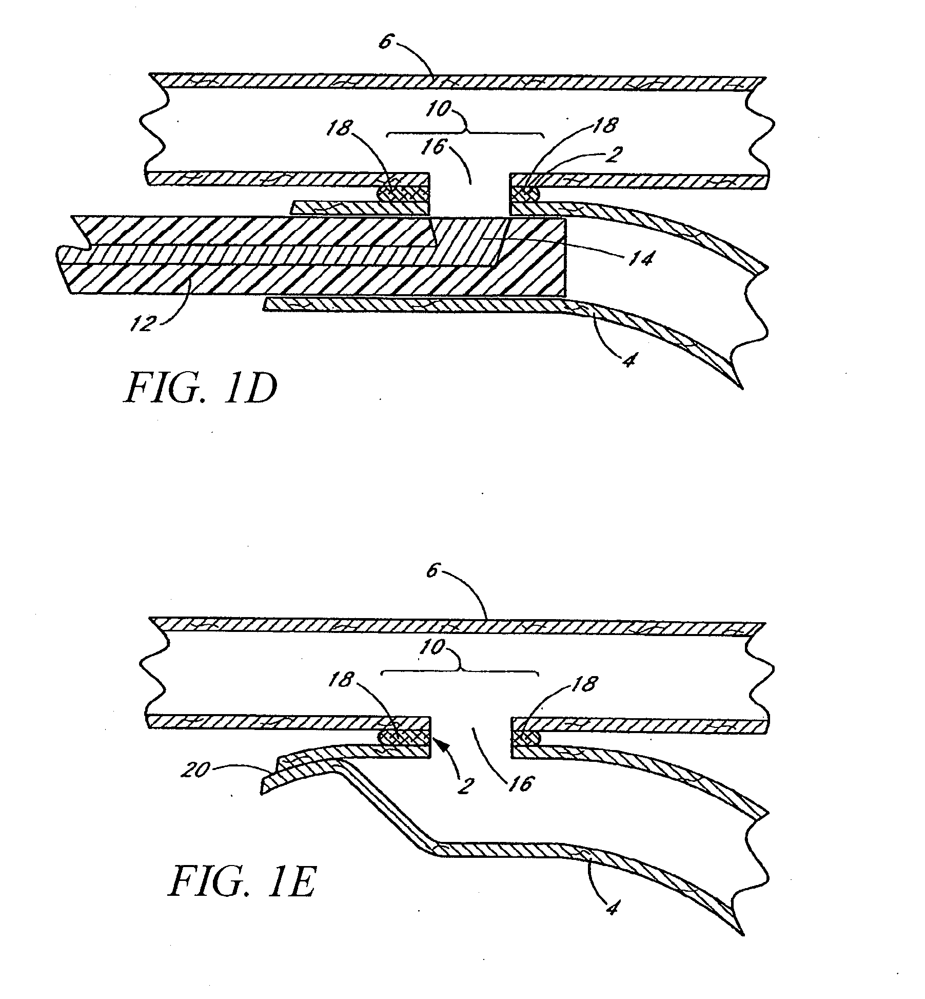 Apparatus and method for performing laser-assisted vascular anastomoses using bioglue