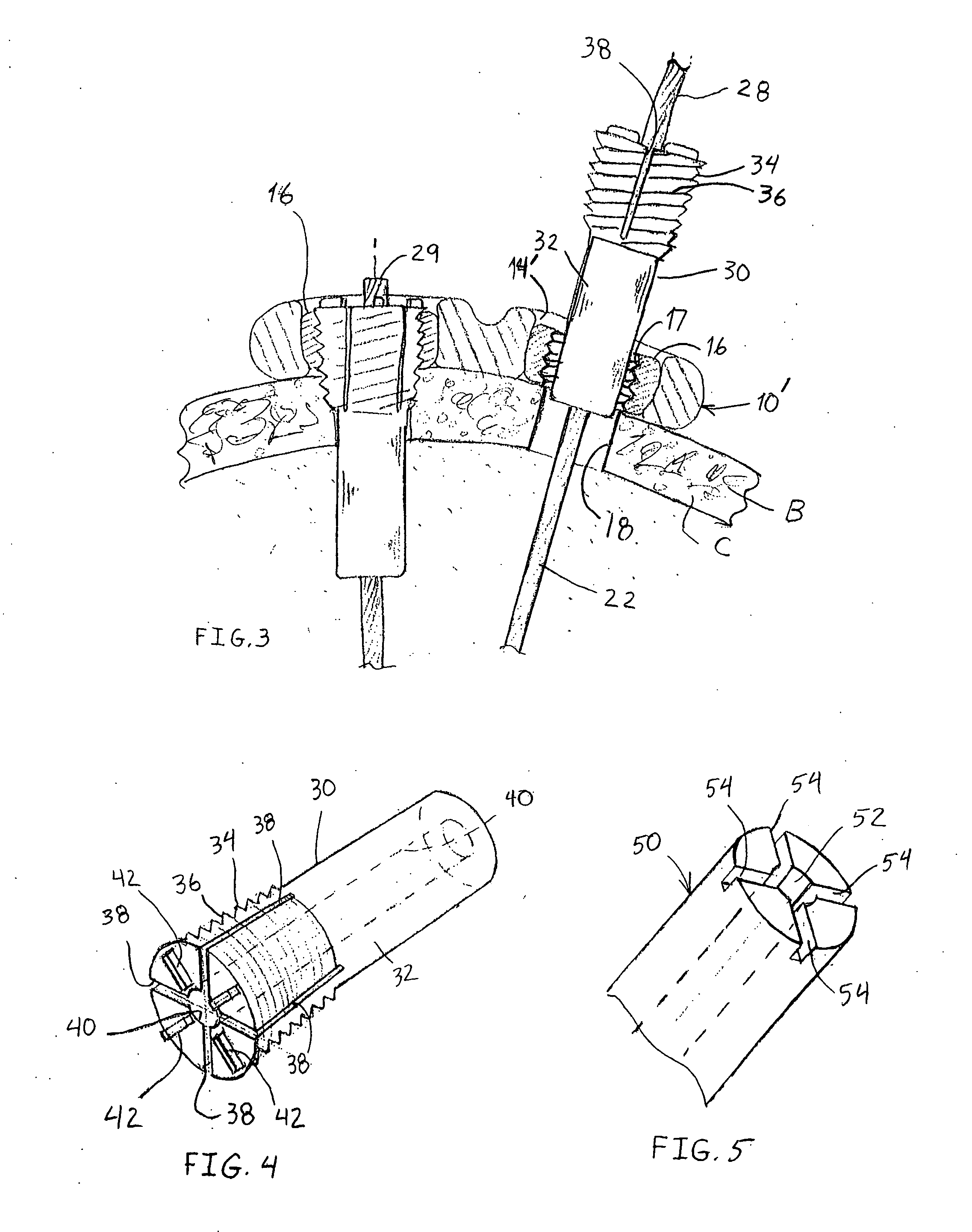 Fastening system for internal fixation
