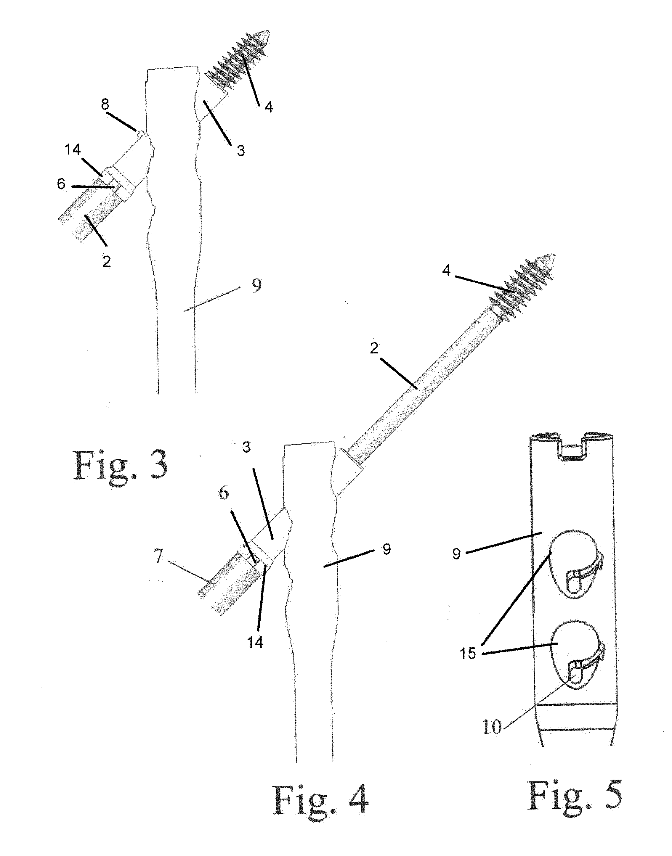 Method for connecting fractured bone
