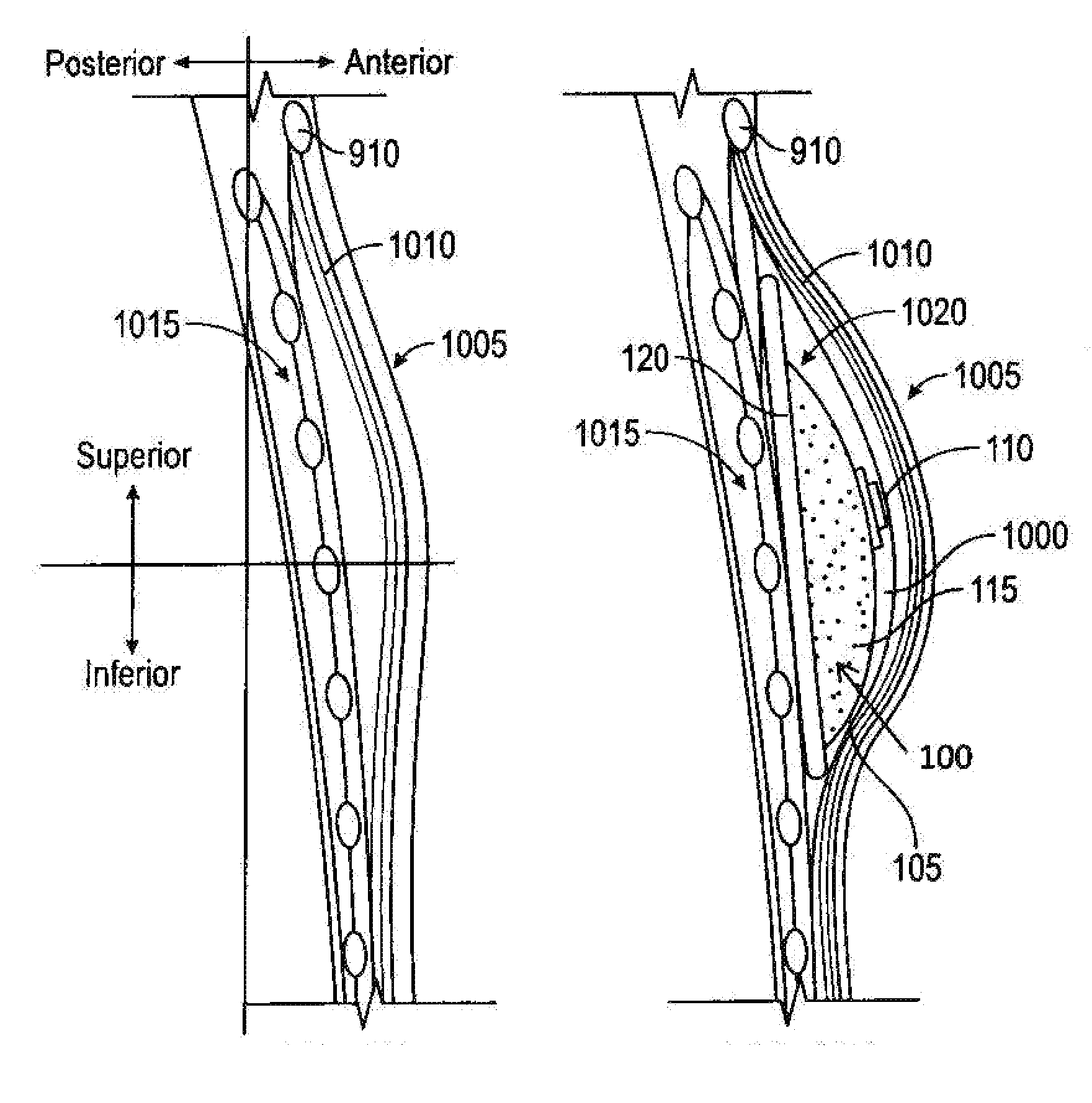 Systems and methods for a tissue expander