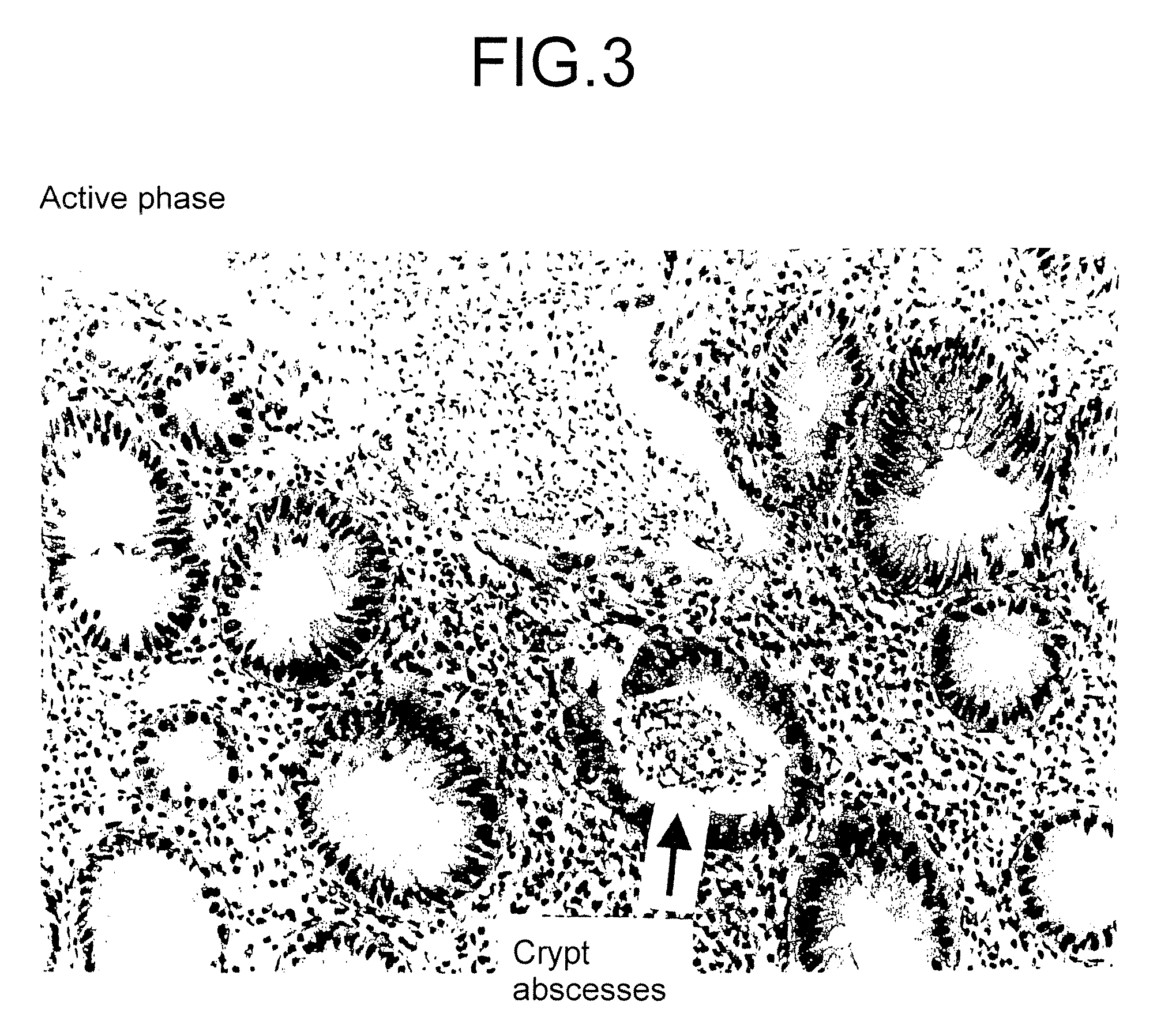 Method for determining the stage of ulcerative colitis or interstitial pneumonitis and reagent kit thereof