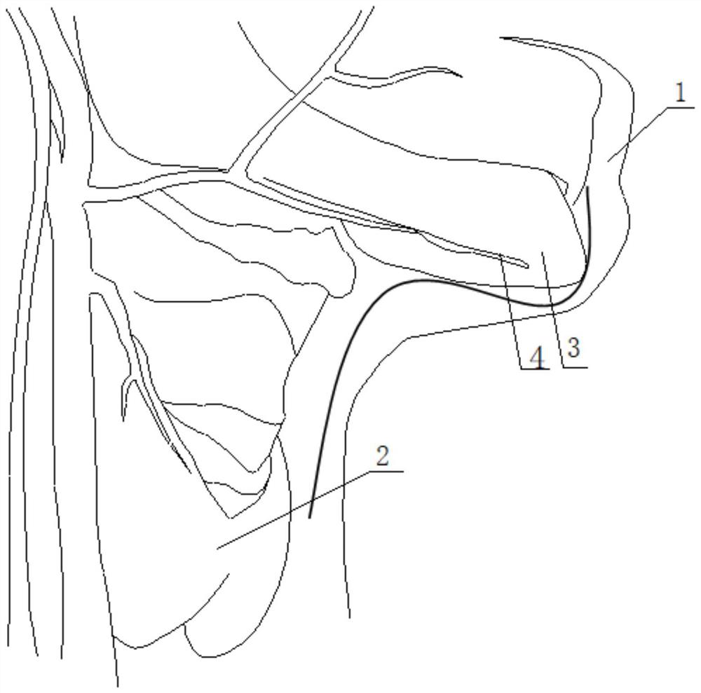 A non-inflatable thyroid retractor