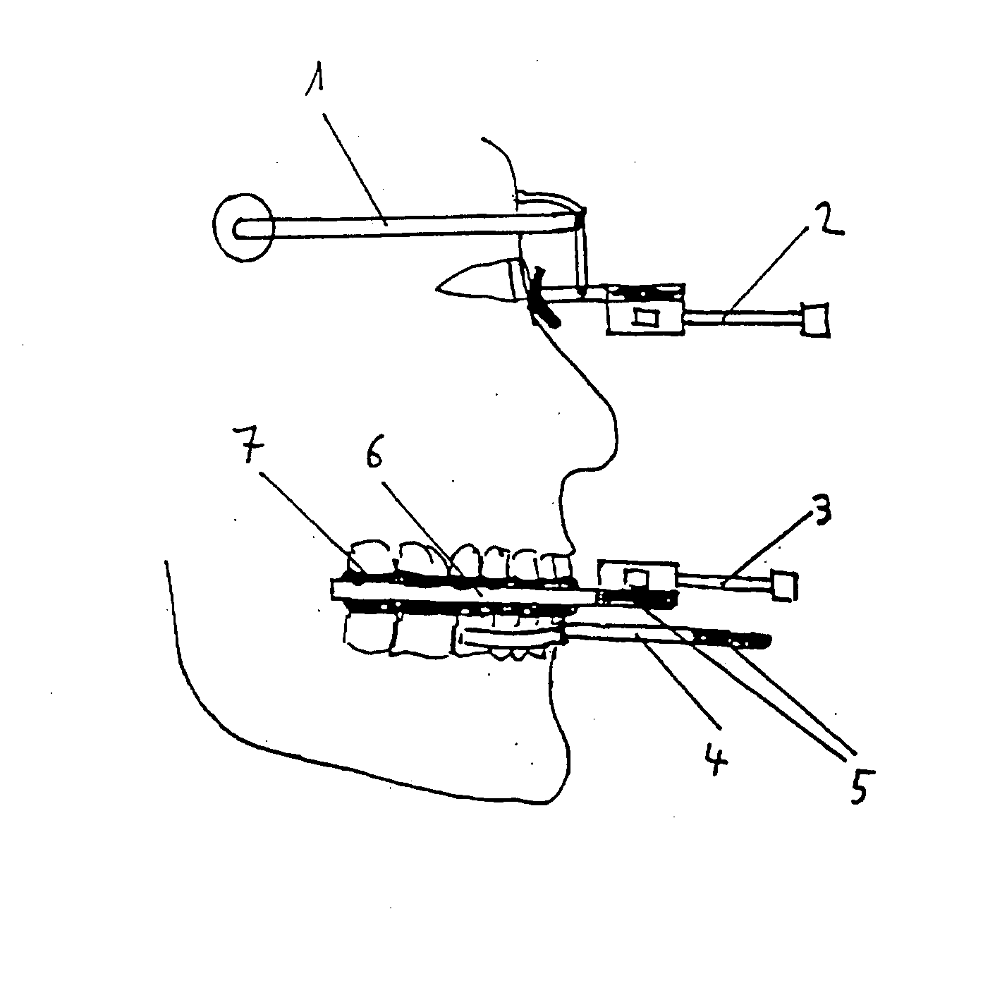 Method and apparatus for the 3-Dimensional analysis of movement of the tooth surfaces of the maxilla in relation to the mandible