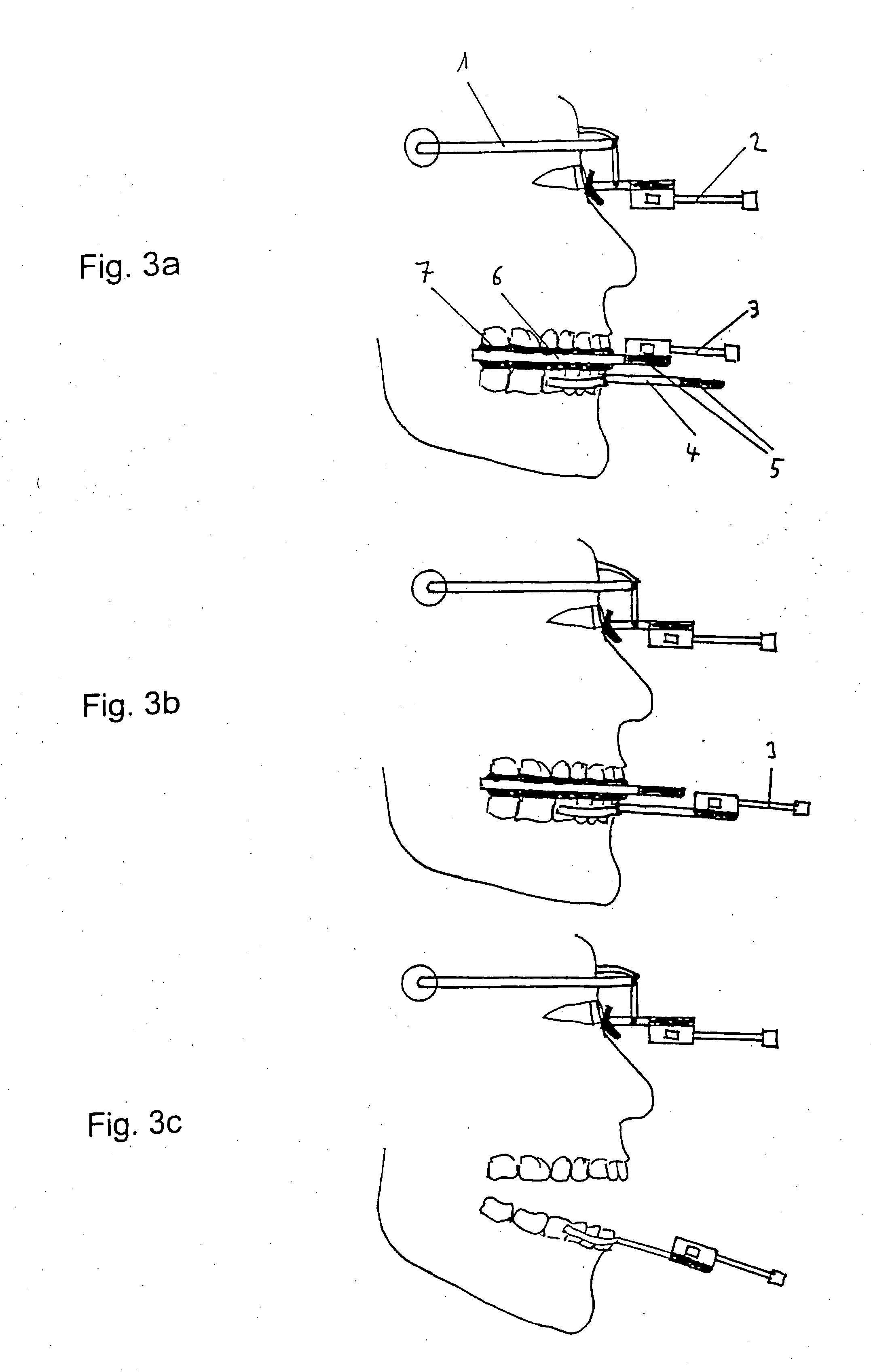 Method and apparatus for the 3-Dimensional analysis of movement of the tooth surfaces of the maxilla in relation to the mandible