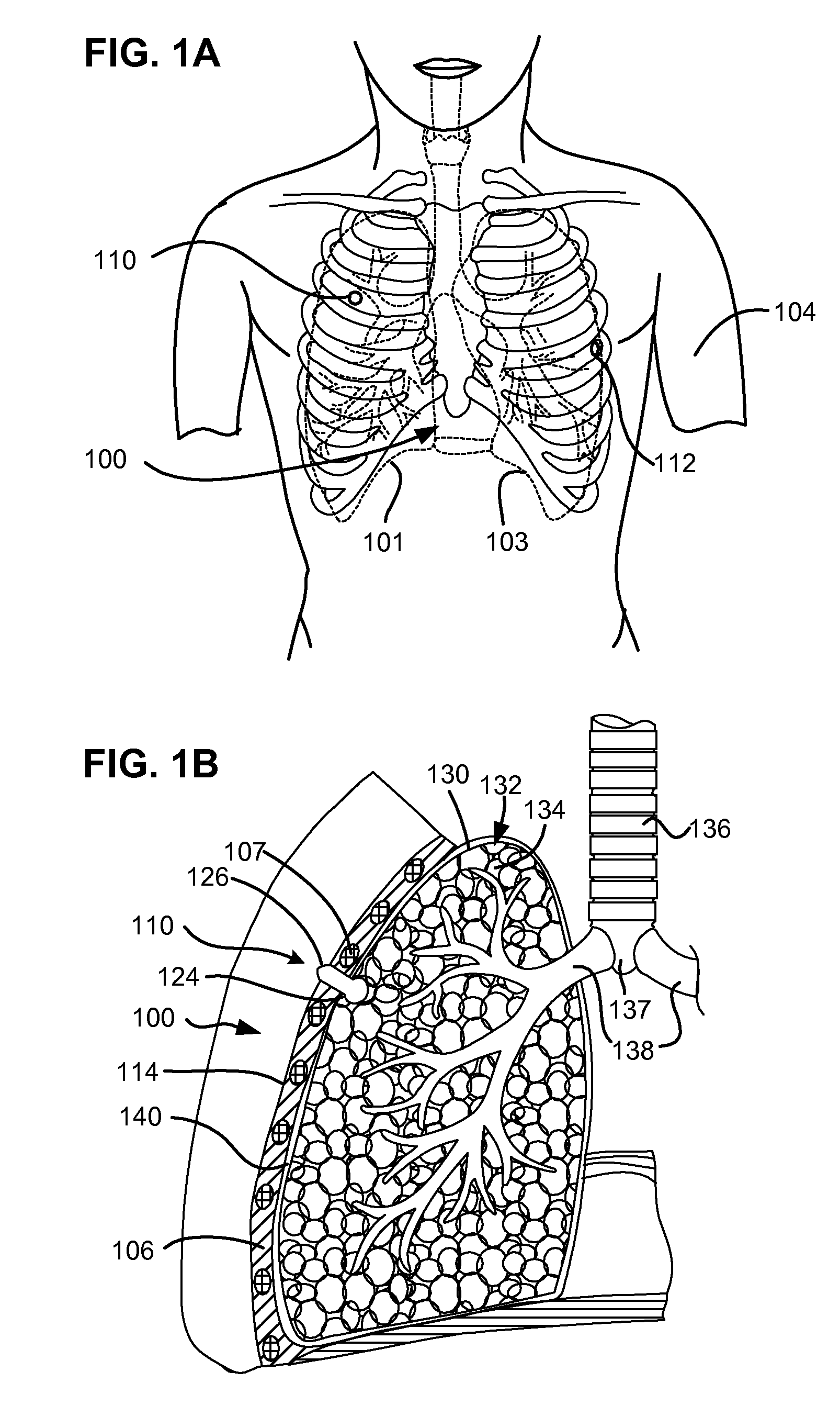 One-piece pneumostoma management system and methods for treatment of chronic obstructive pulmonary disease