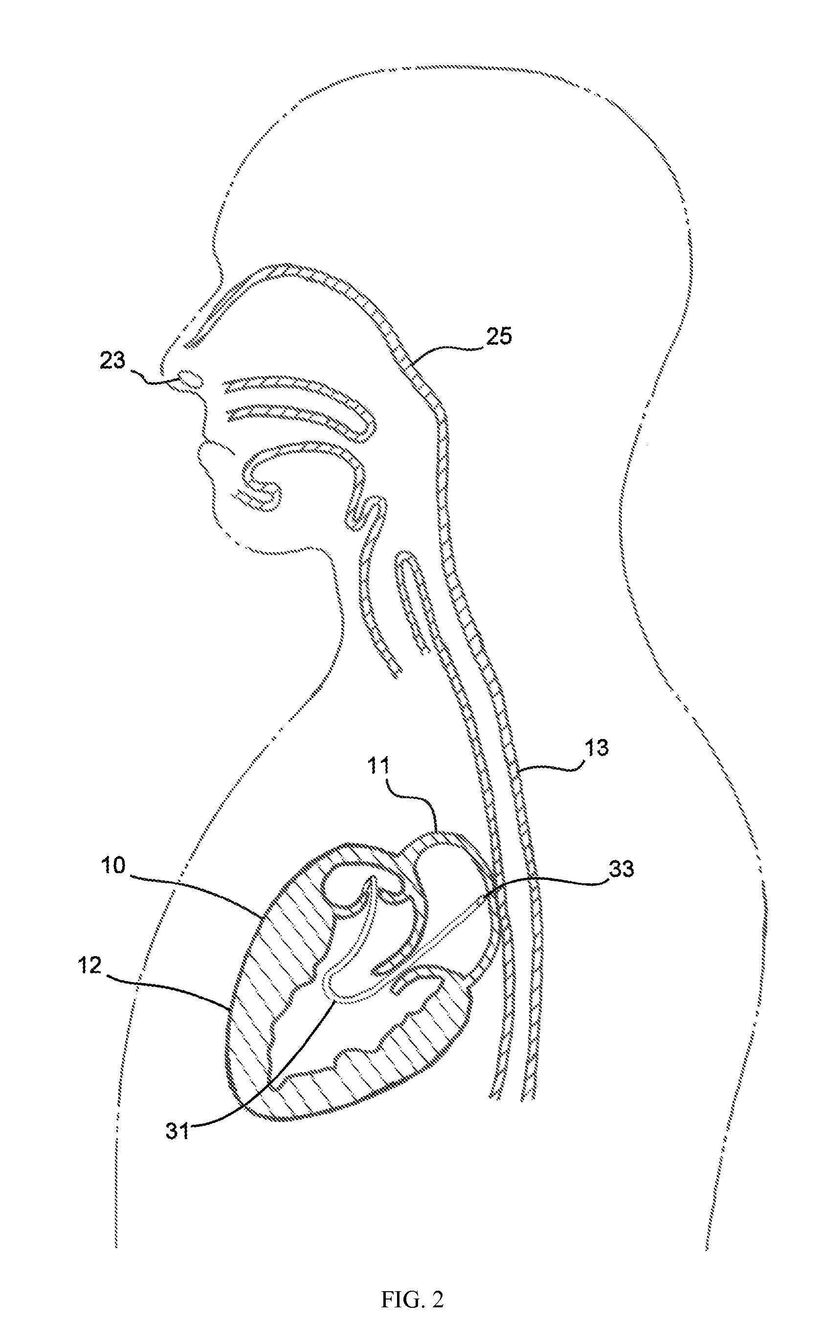 Device and method for esophageal cooling