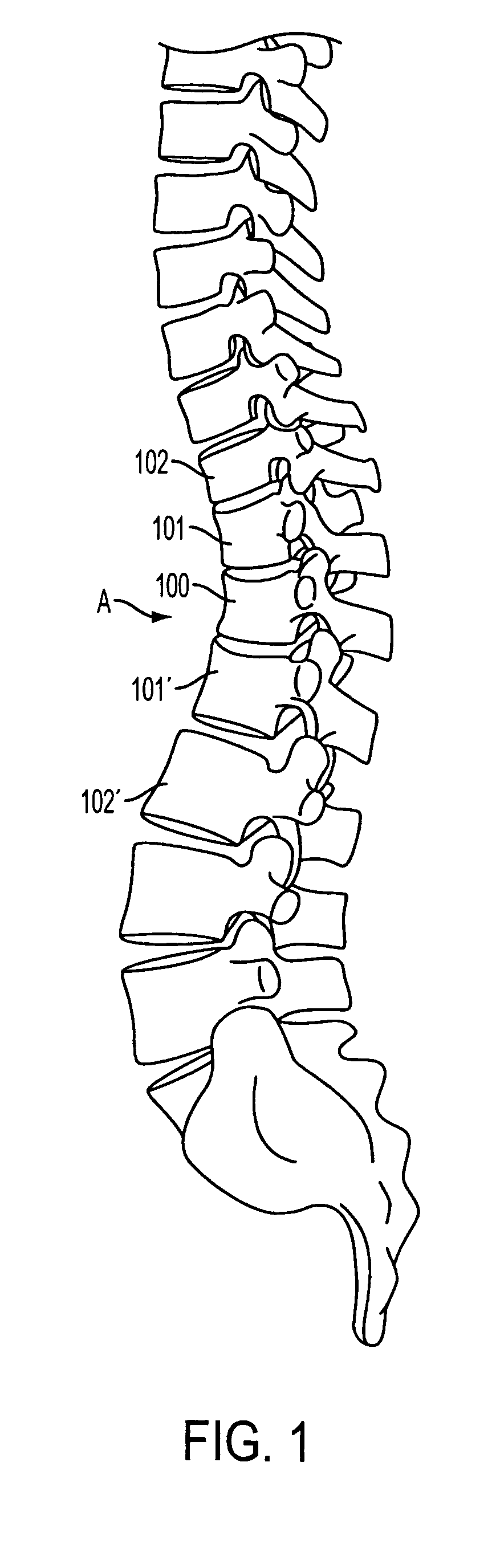 Device and method for dynamic spinal fixation for correction of spinal deformities