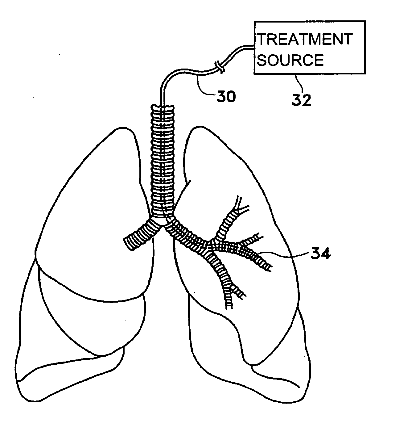 Methods for treating airways