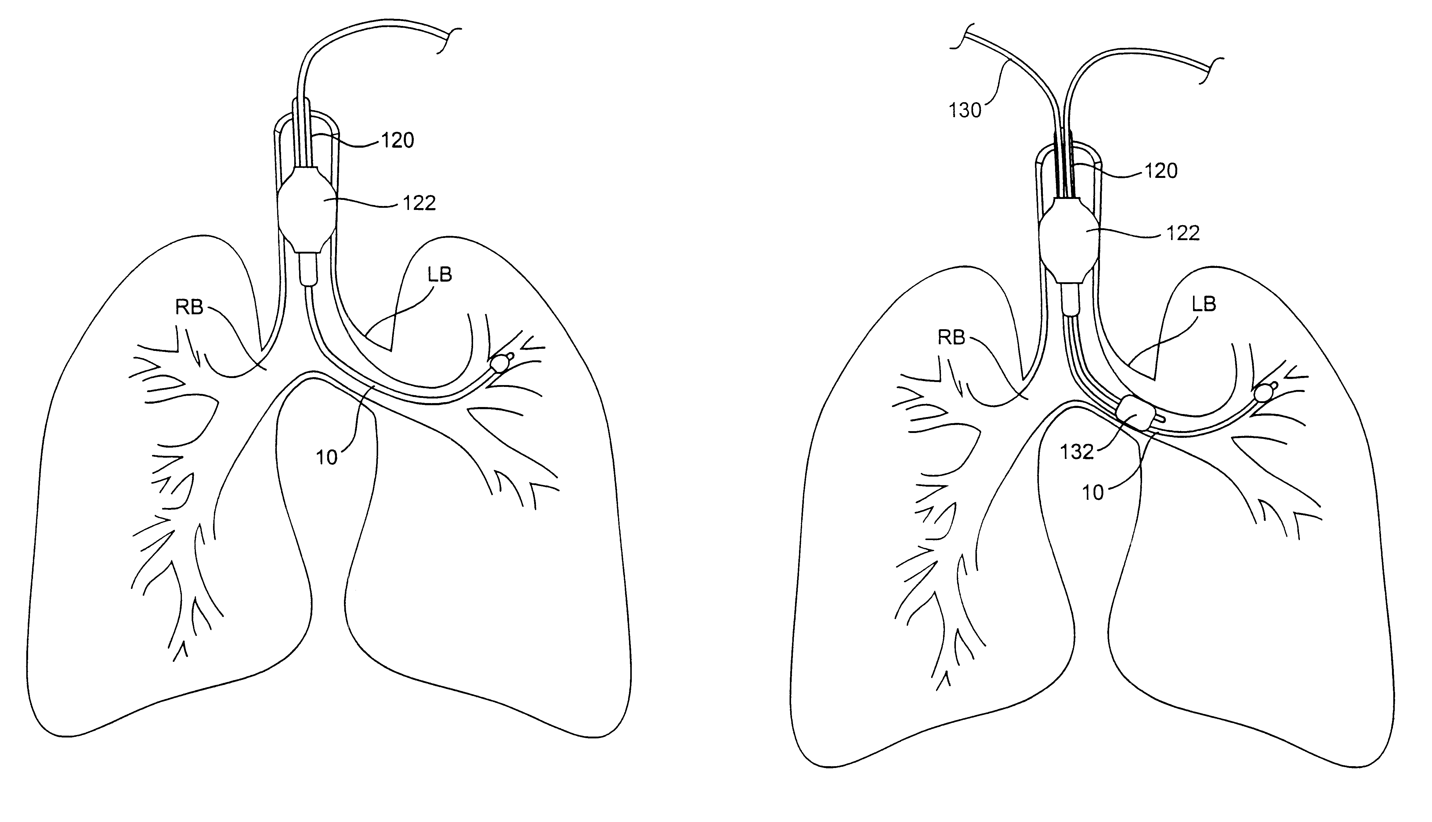 Methods, systems, and kits for lung volume reduction