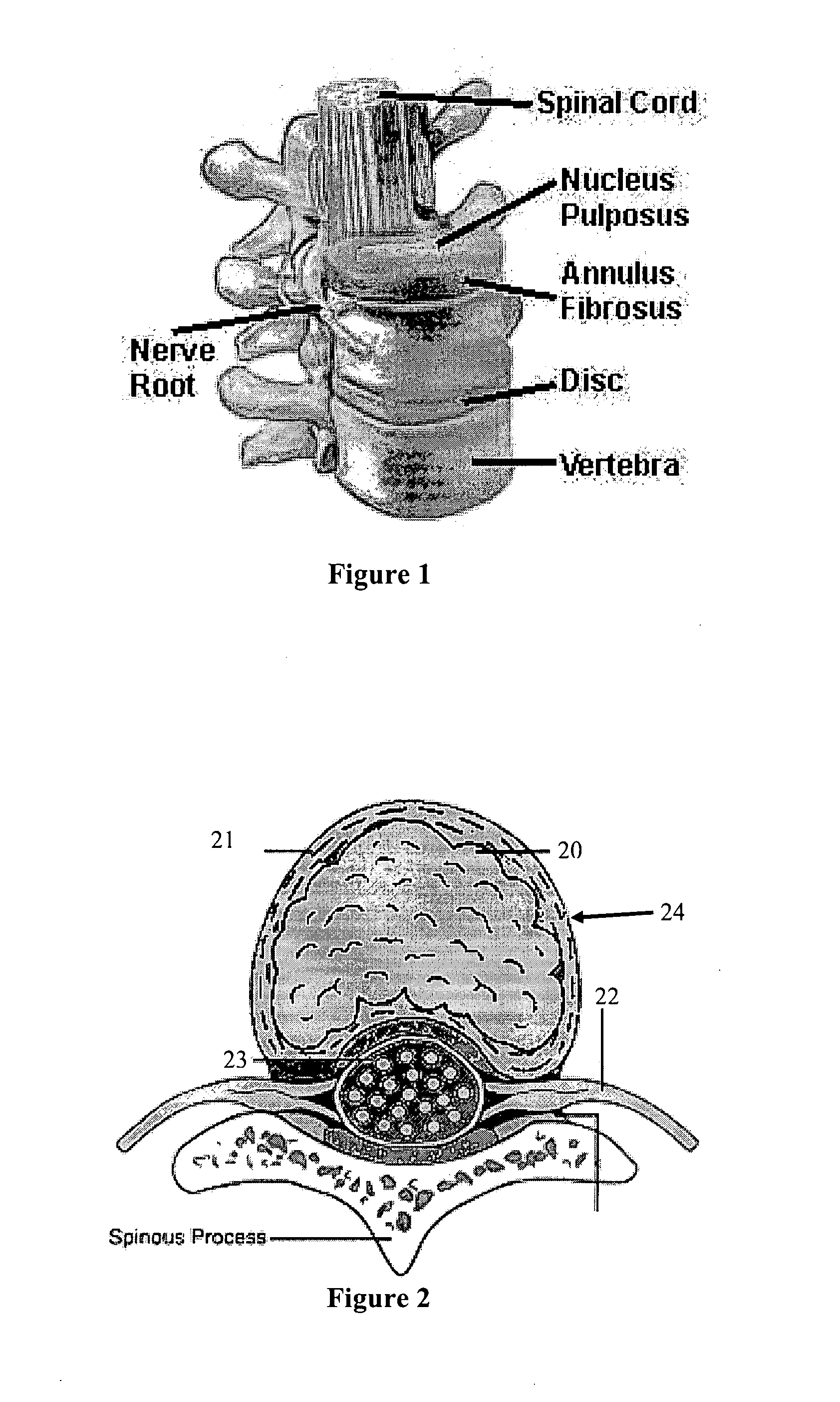 Implement and method to extract nucleus from spine intervertebral disc