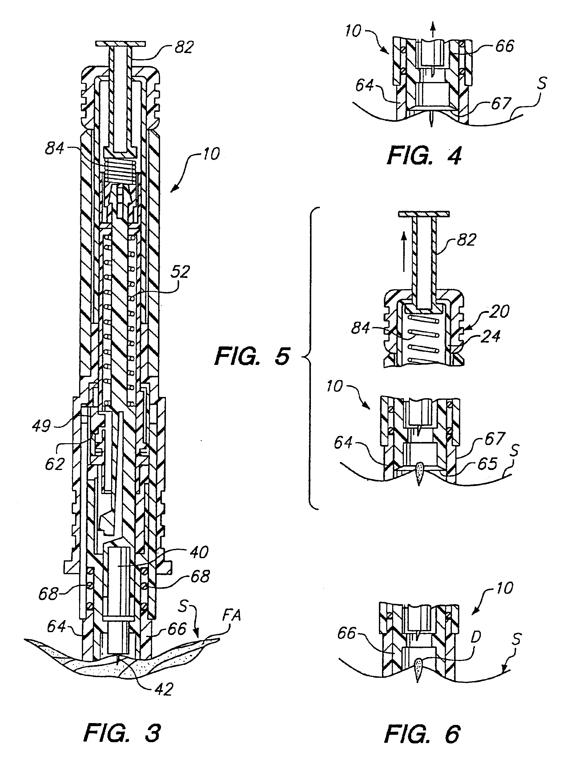 Methods and apparatus for suctioning and pumping body fluid from an incision