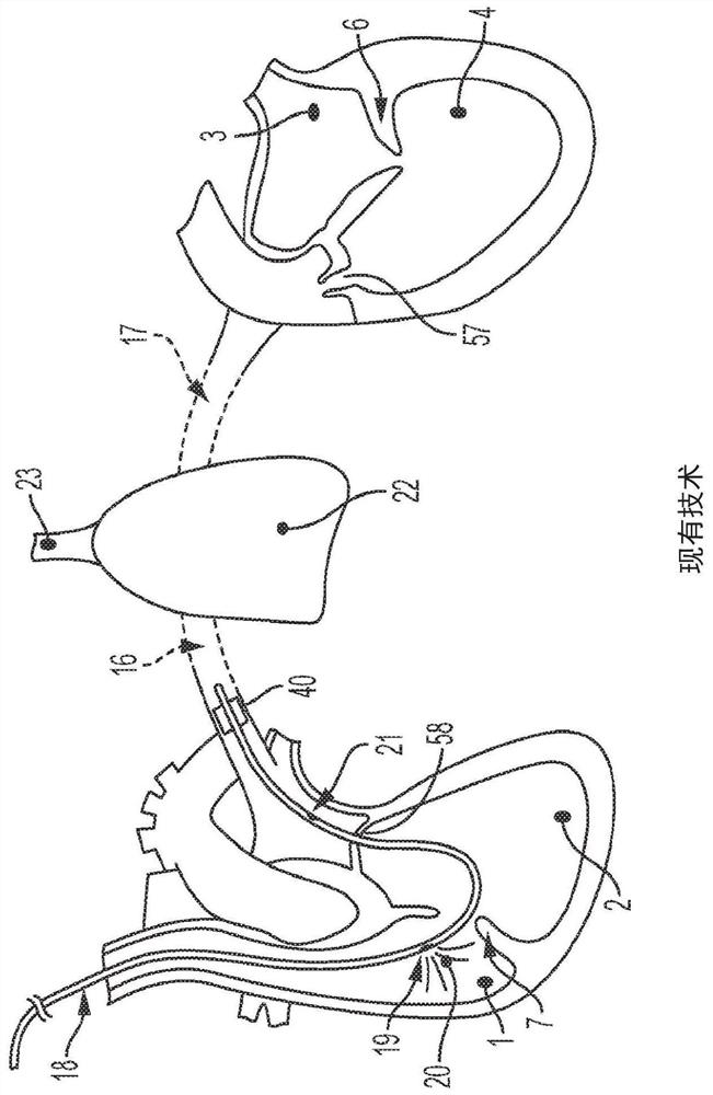 Implantable cardiac sensors