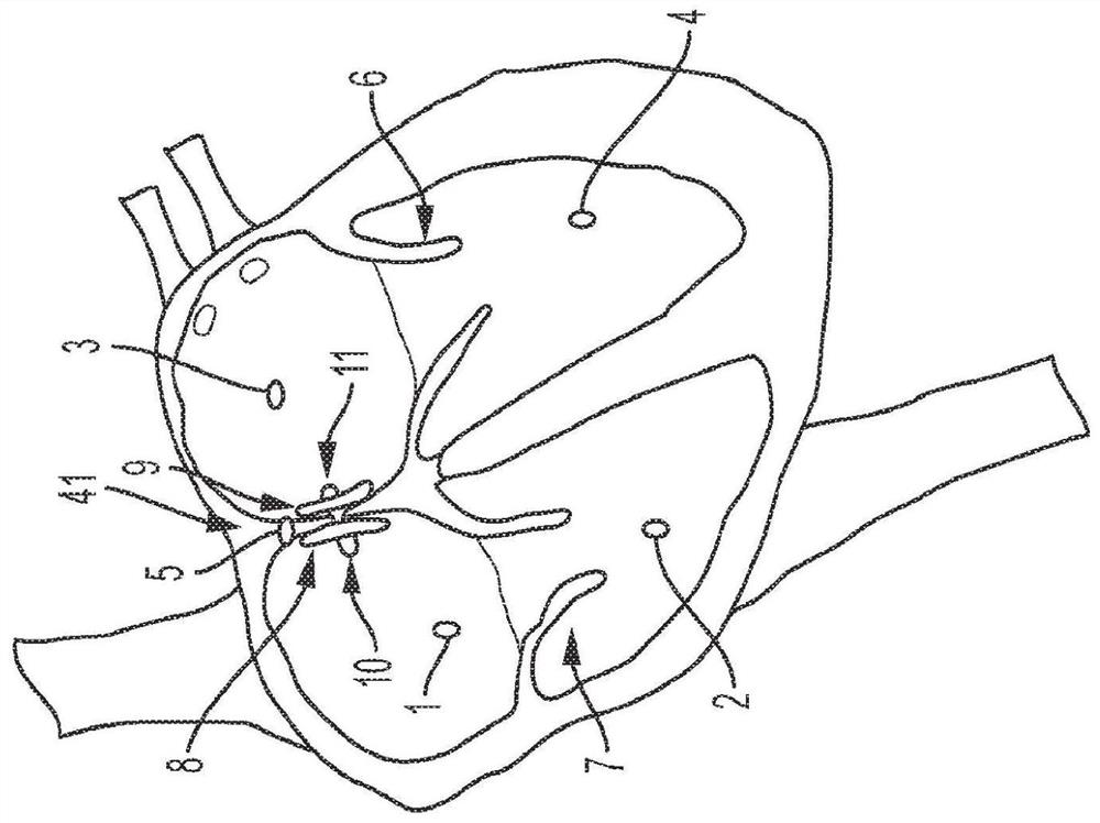 Implantable cardiac sensors