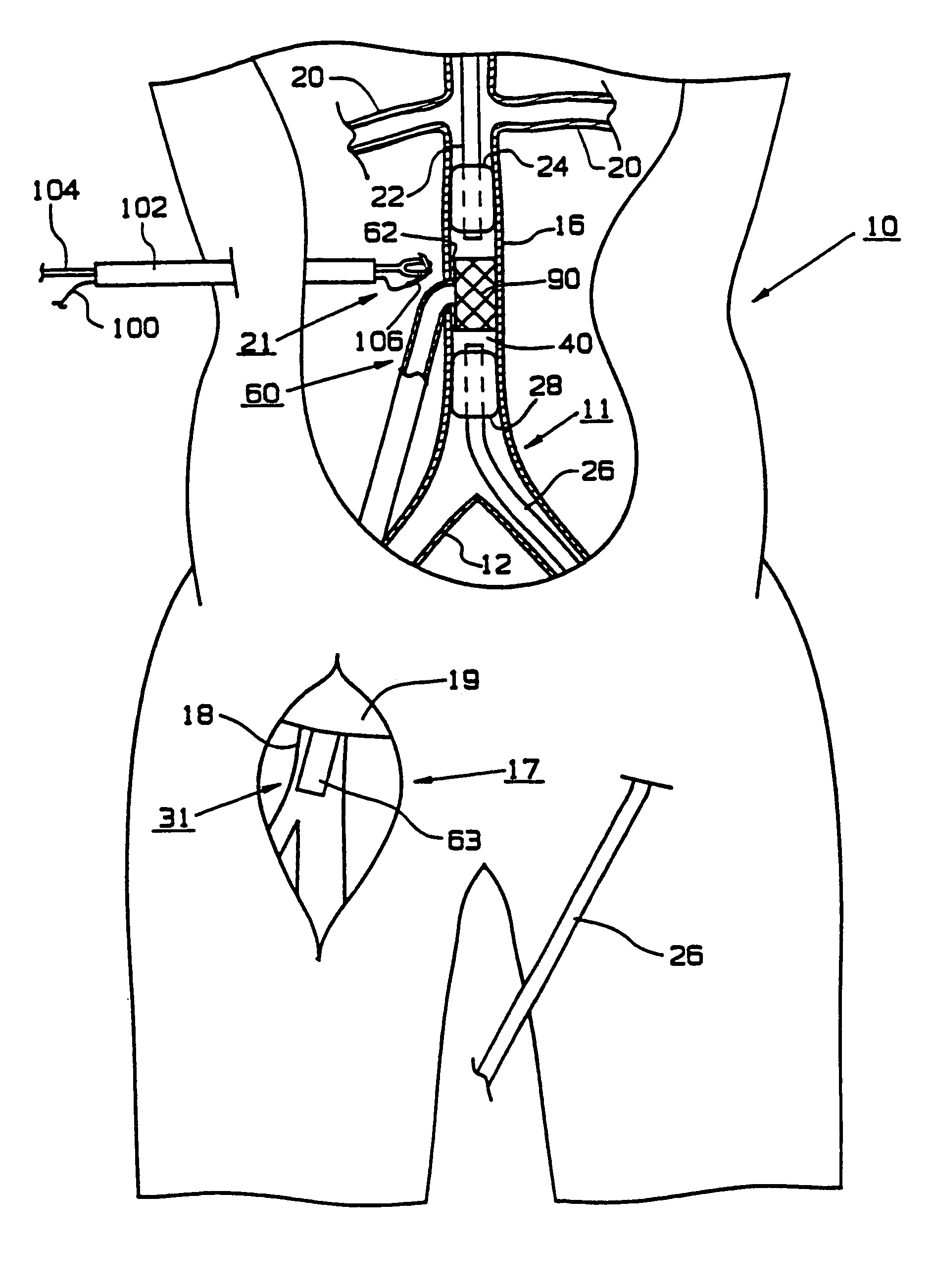 Endoscopic bypass grafting method utilizing an inguinal approach