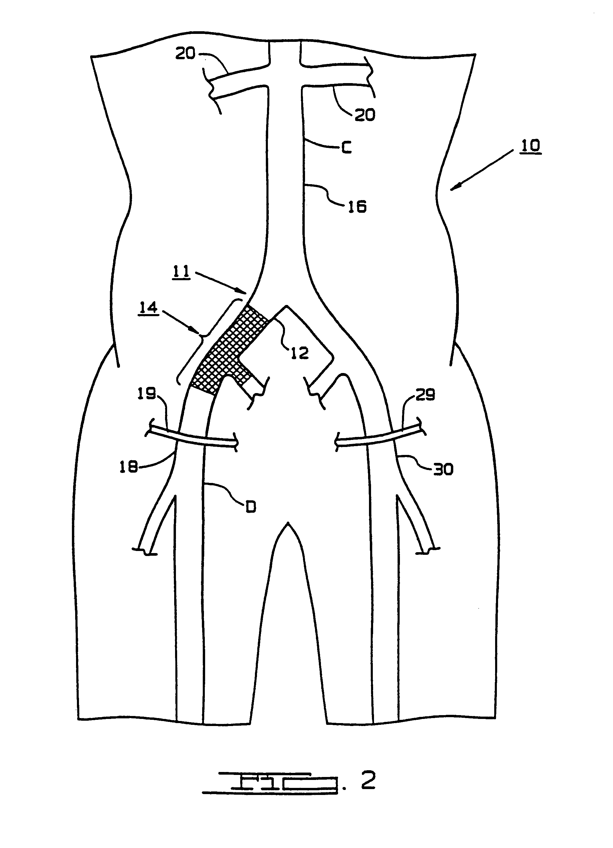 Endoscopic bypass grafting method utilizing an inguinal approach