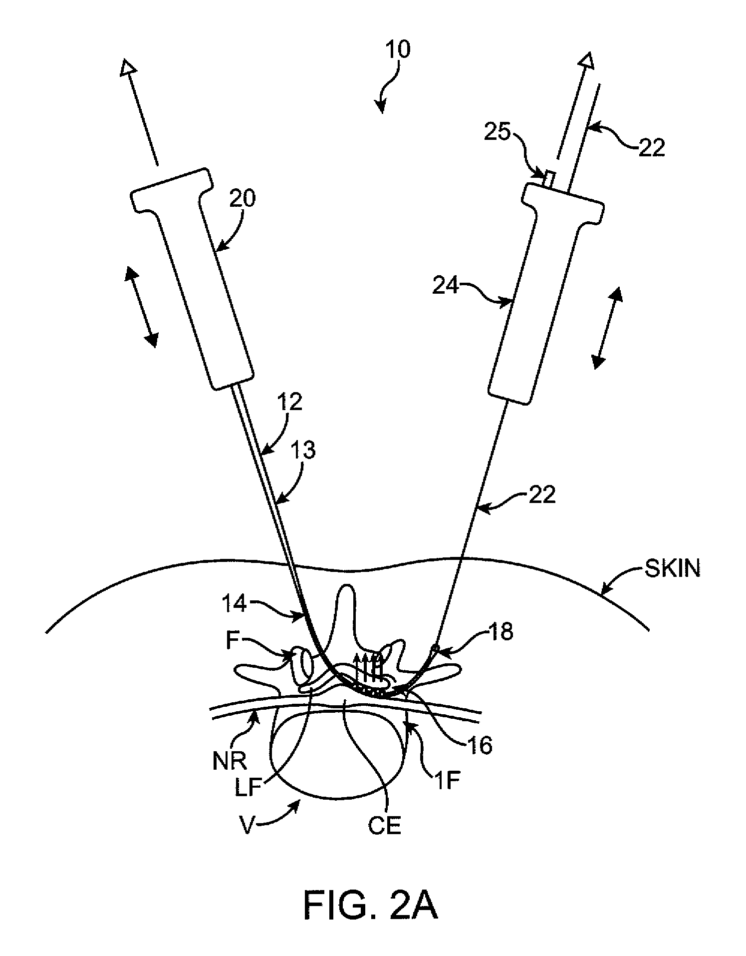 Flexible Tissue Removal Devices and Methods