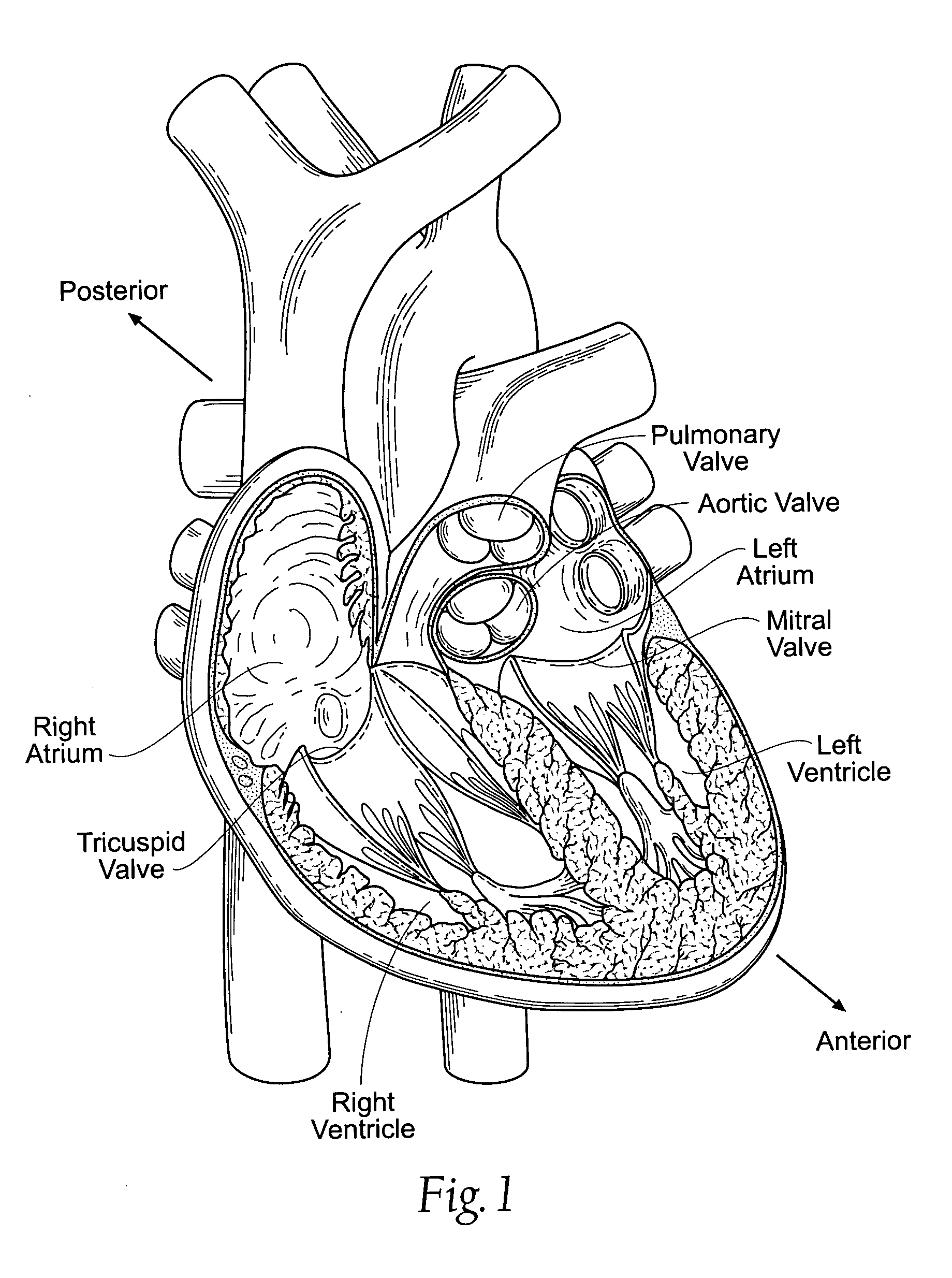 Devices, systems, and methods for retaining a native heart valve leaflet