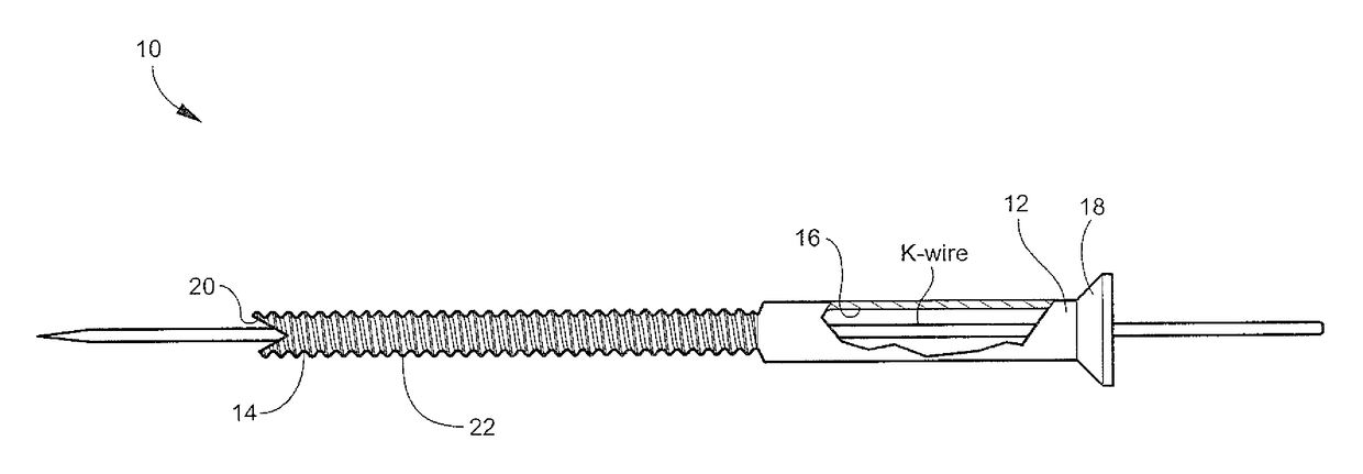 Cannulated orthopedic screw and method of reducing and fixing a fracture of the lateral malleolus