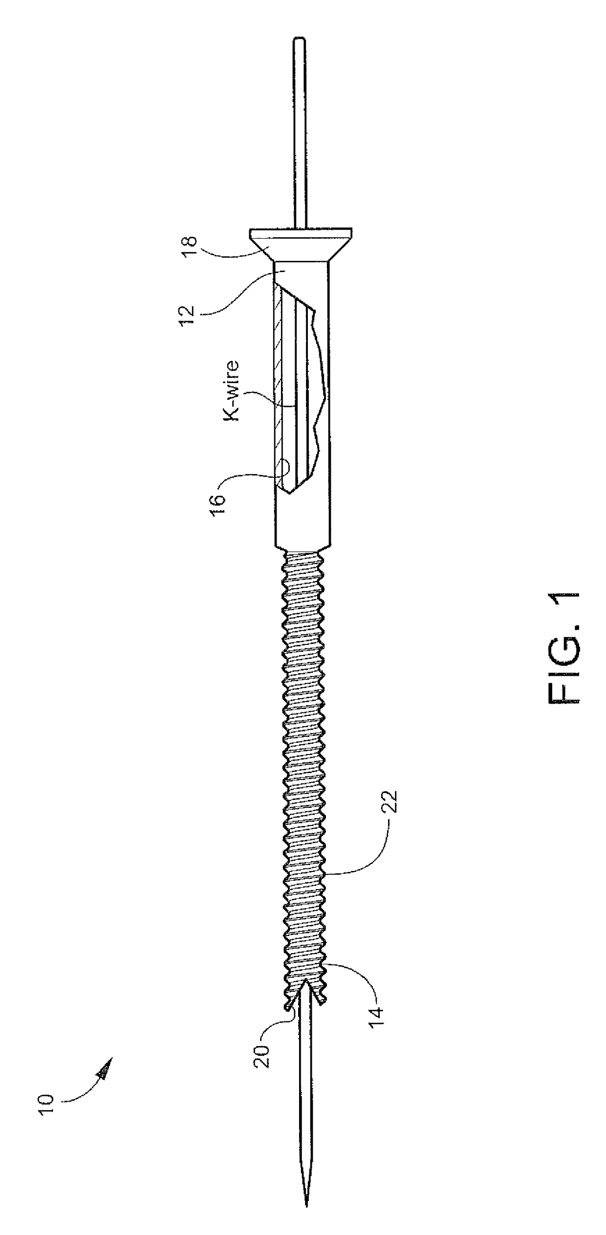 Cannulated orthopedic screw and method of reducing and fixing a fracture of the lateral malleolus