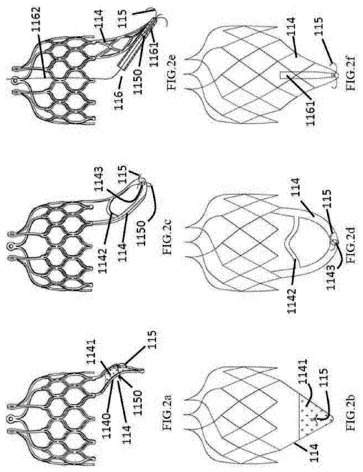 Heart valve prosthesis anchored to interventricular septum and conveying and releasing method thereof