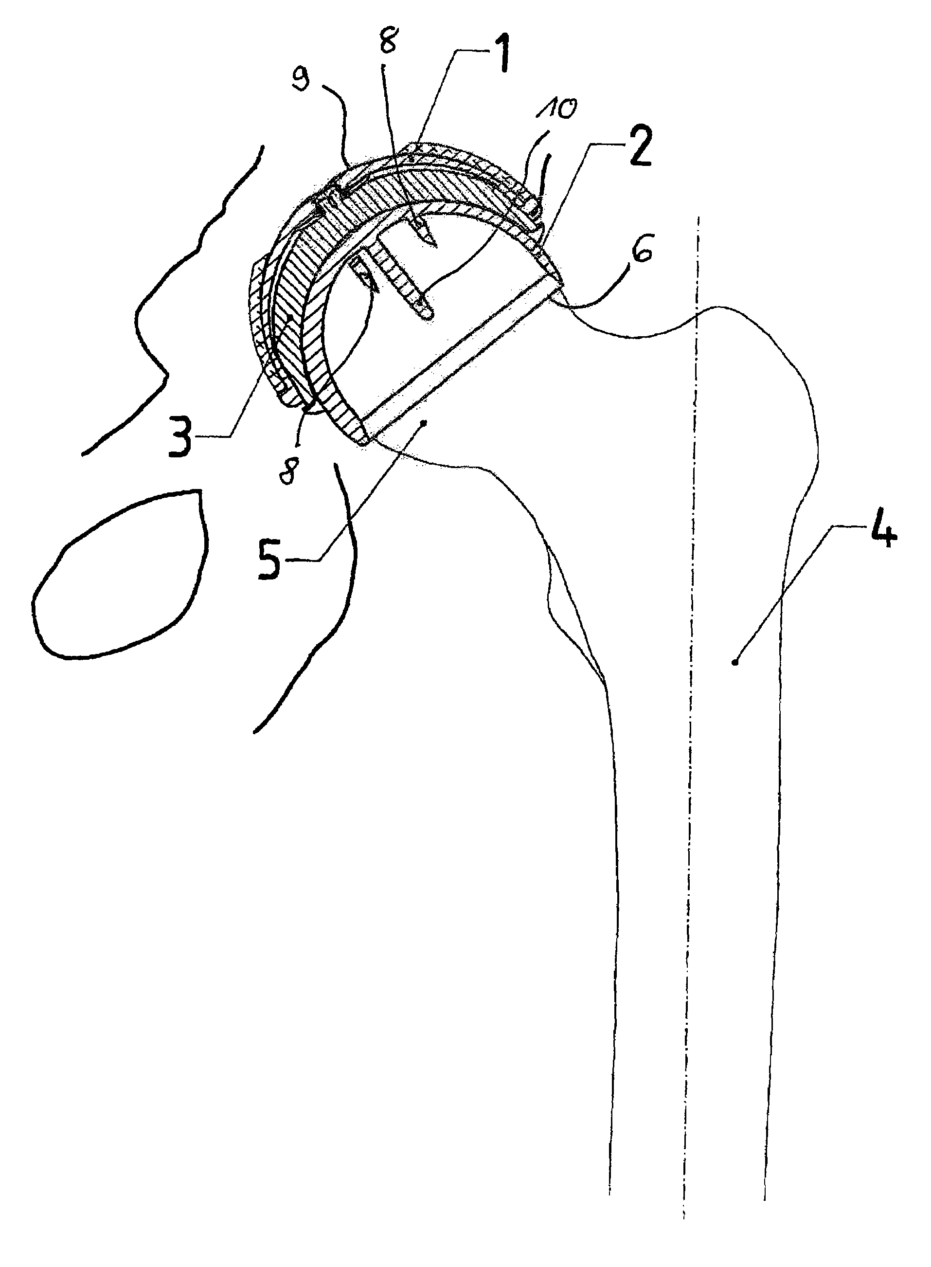 Set for creating an offset-resurfacing hip-joint implant