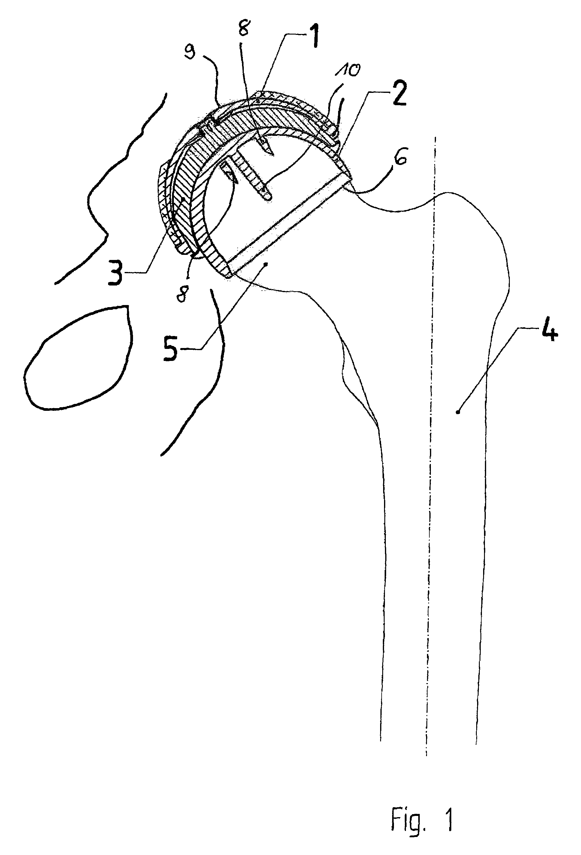 Set for creating an offset-resurfacing hip-joint implant