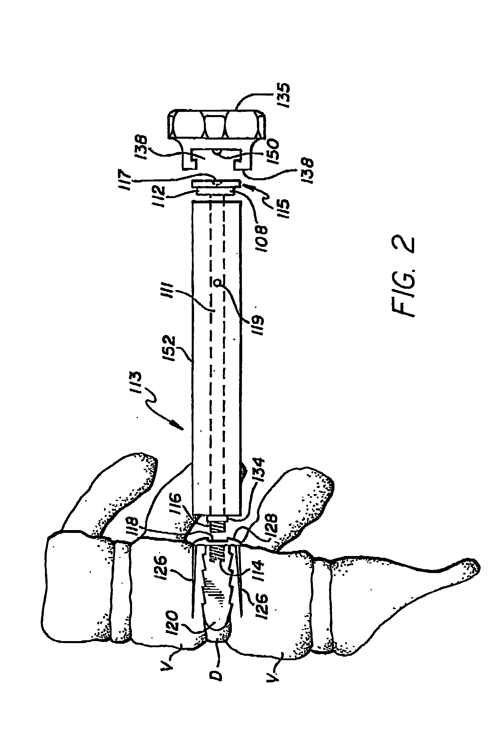 Apparatus and method of inserting spinal implants