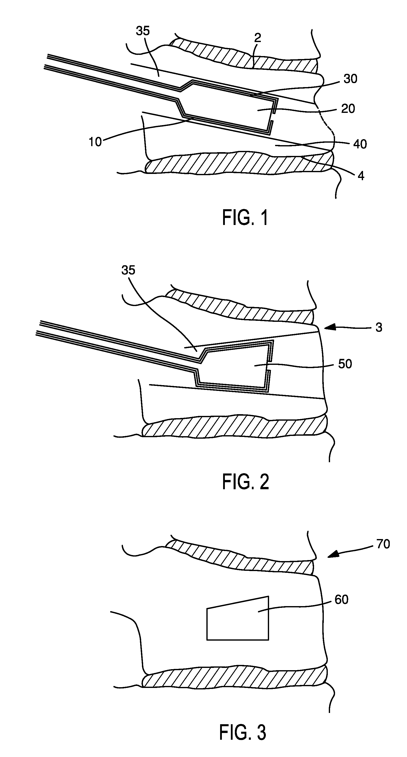 Devices and methods for the treatment of bone fracture