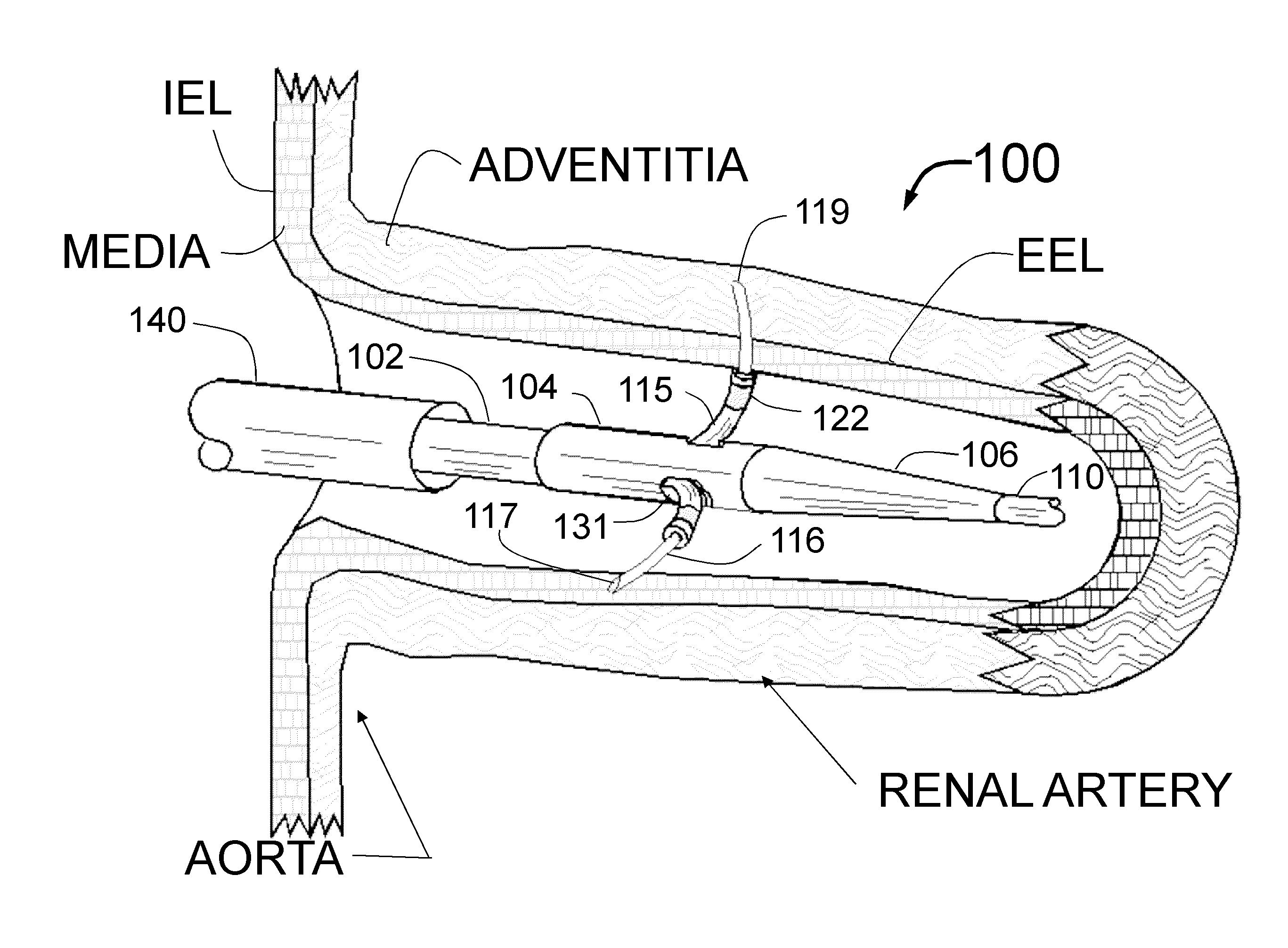 Transvascular catheter for extravascular delivery