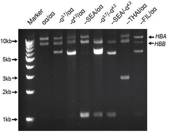 Method and kit for simultaneously detecting multiple mutations at hba1/2 and hbb gene loci