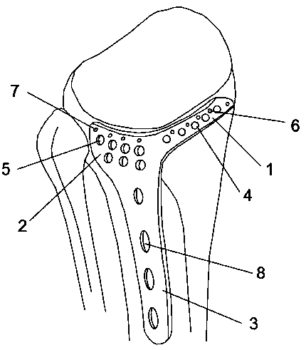 Fixing device for tibial plateau hyperextension fracture