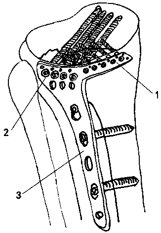 Fixing device for tibial plateau hyperextension fracture