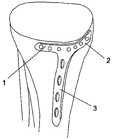 Fixing device for tibial plateau hyperextension fracture