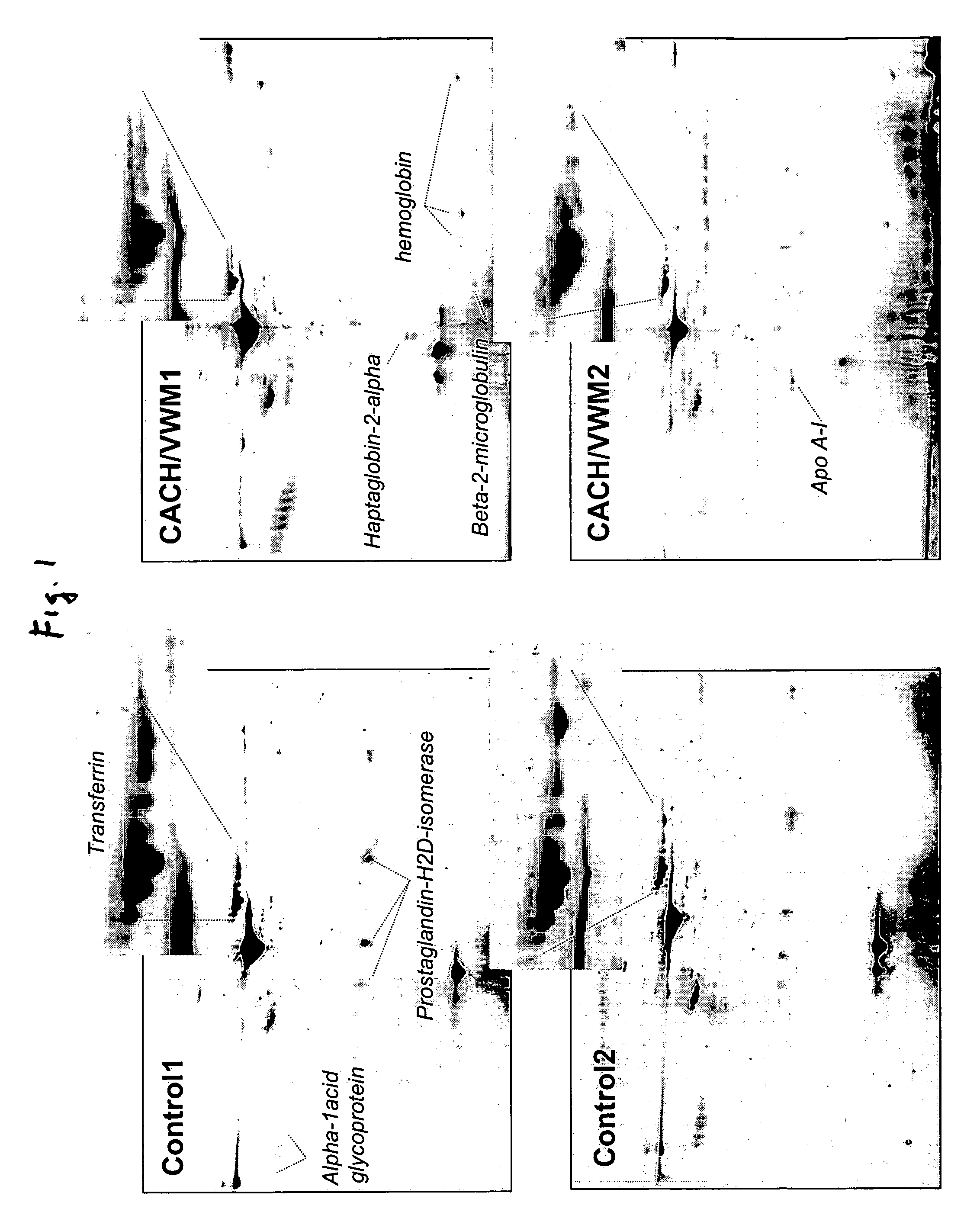 Biochemical marker for diagnosing a leukodystrophy