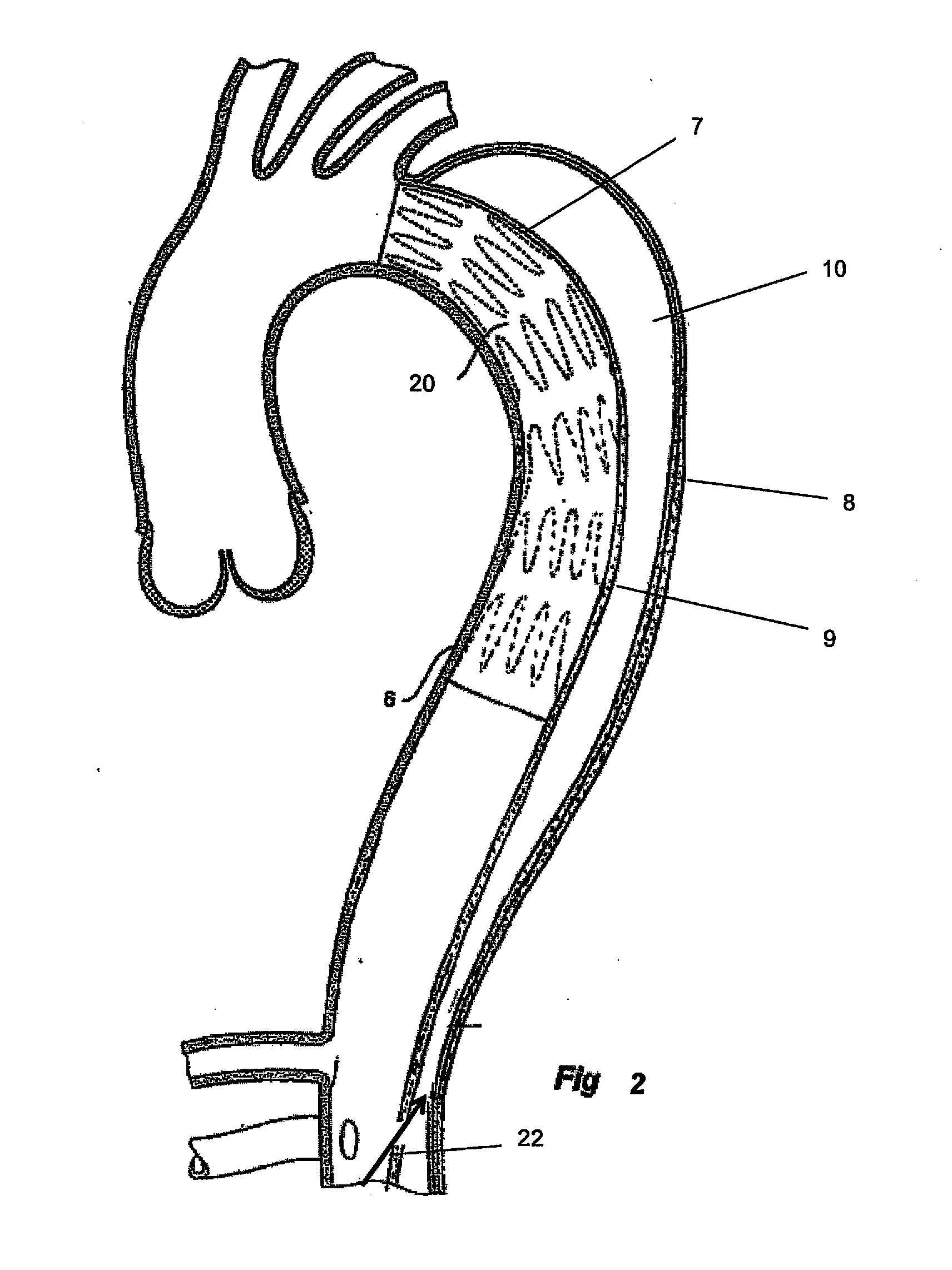 Device and method for treating vascular dissections
