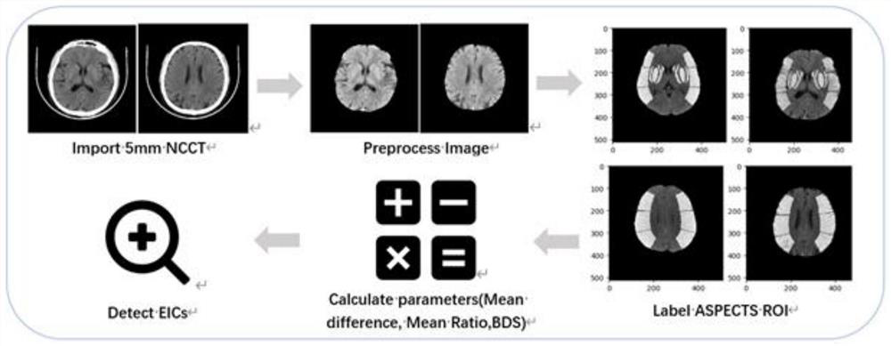 Method for auxiliary diagnosis of acute ischemic stroke based on CT flat scanning images