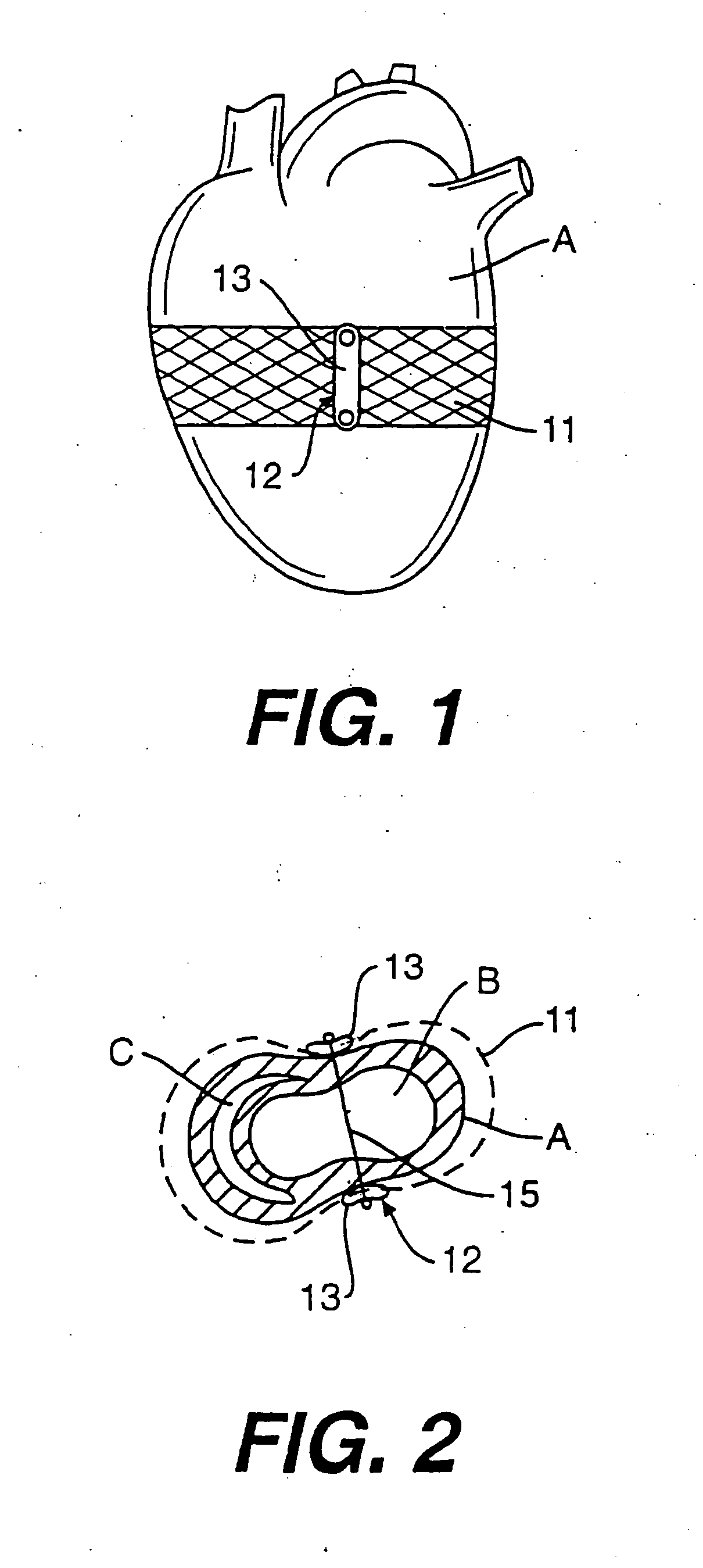Heart wall tension reduction apparatus and method