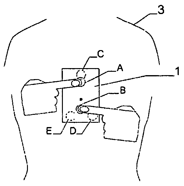 Apparatus and method for cordless recording and telecommunication transmission of three special ECG leads and their processing