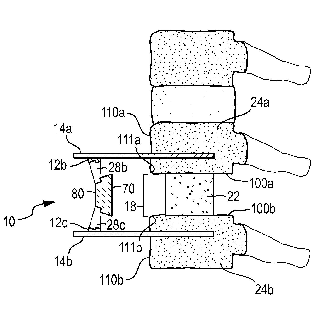 Low-profile anterior vertebral plate assemblies and methods of use