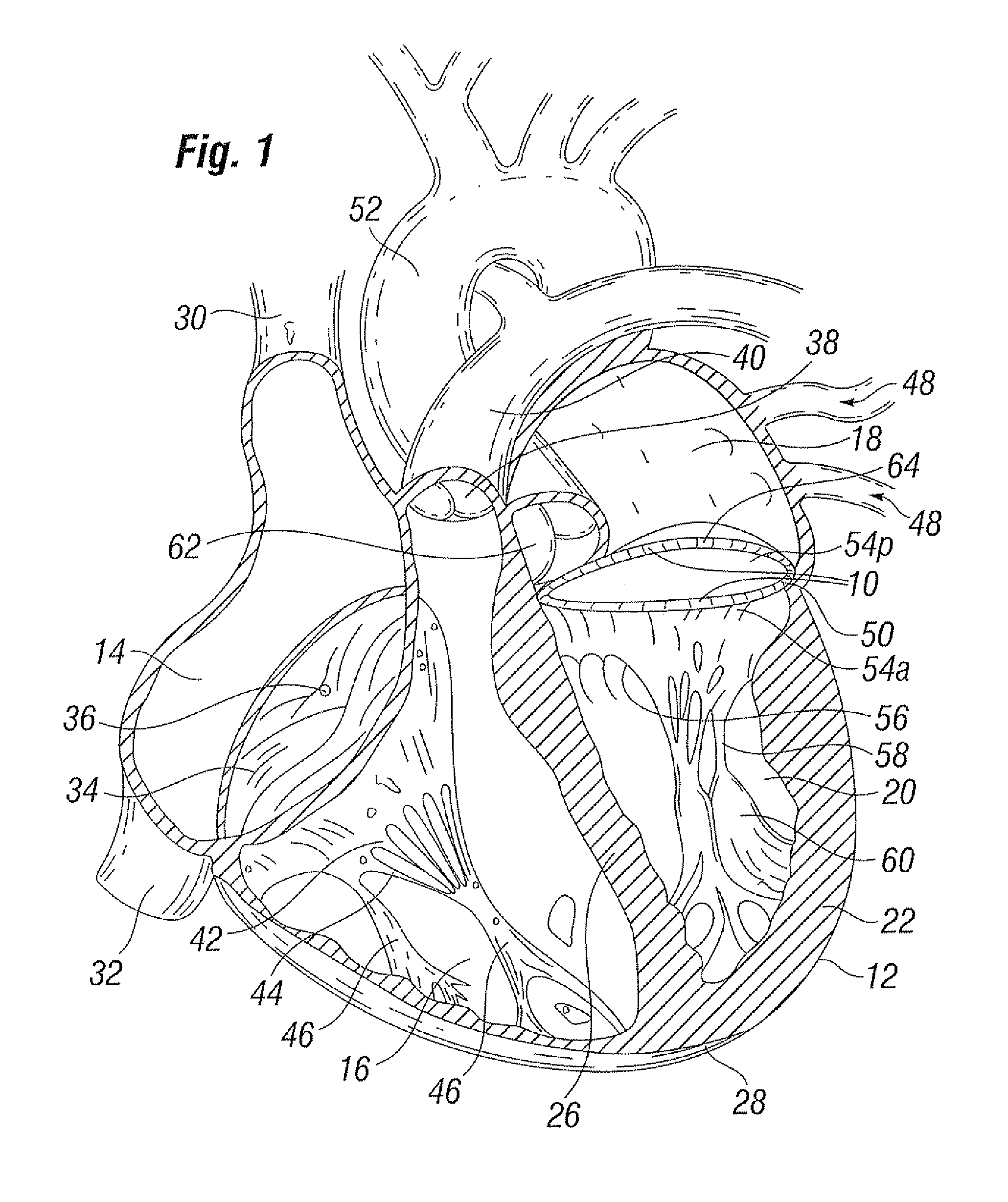 Transformable annuloplasty ring configured to receive a percutaneous prosthetic heart valve implantation